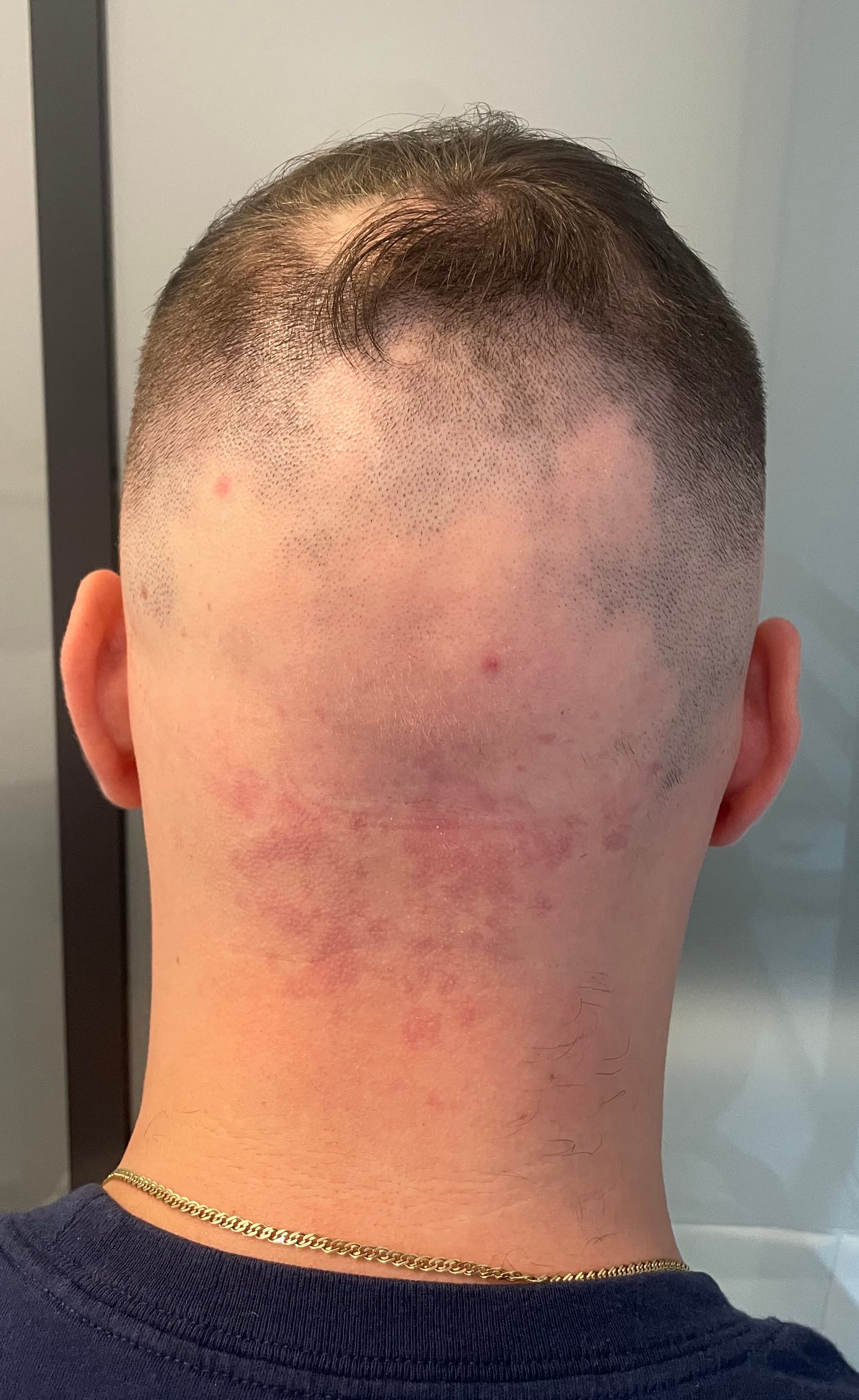 Înainte de micropigmentare scalp - Alopecie Areată