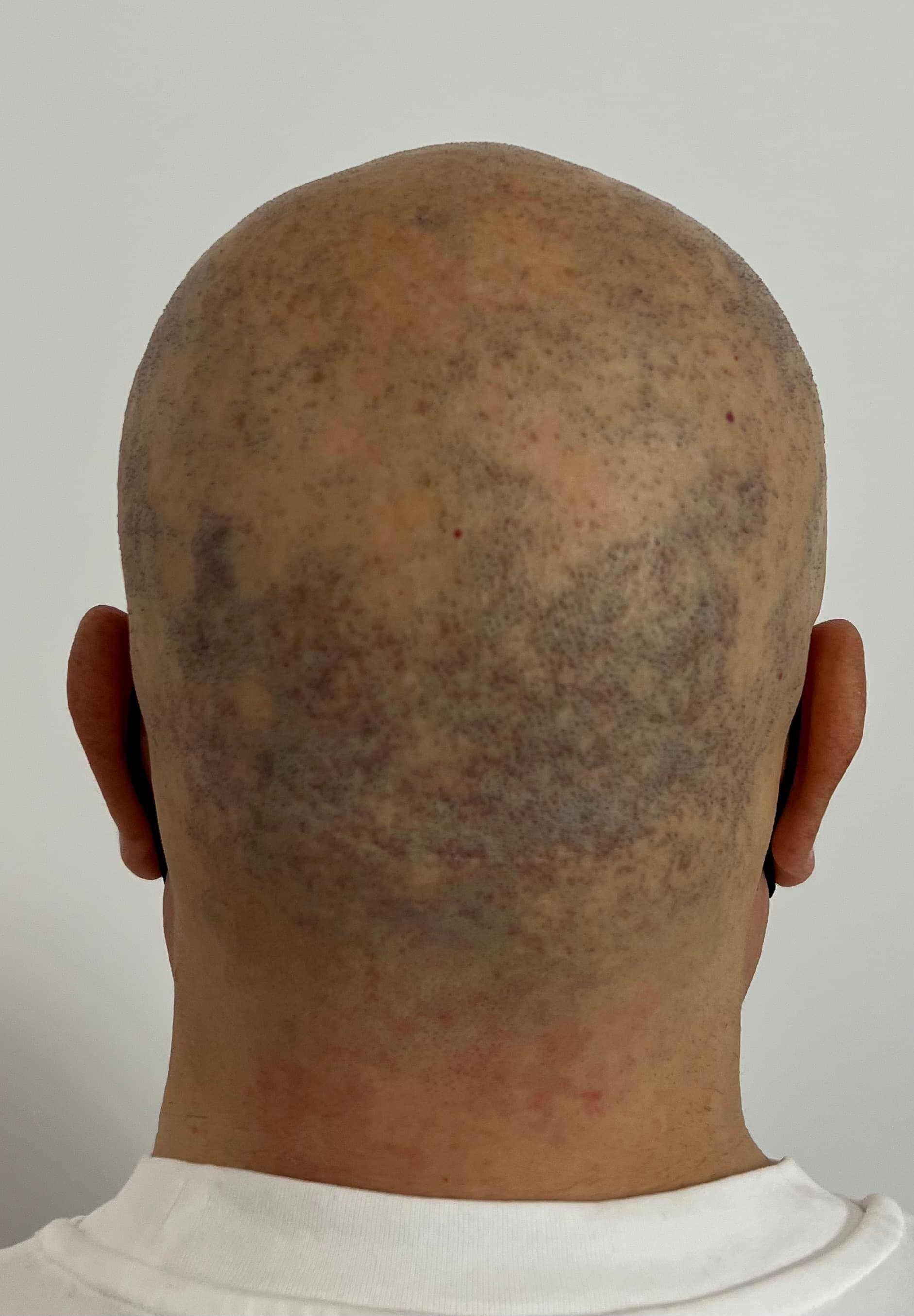 Înainte de micropigmentare scalp - Alopecie Areată