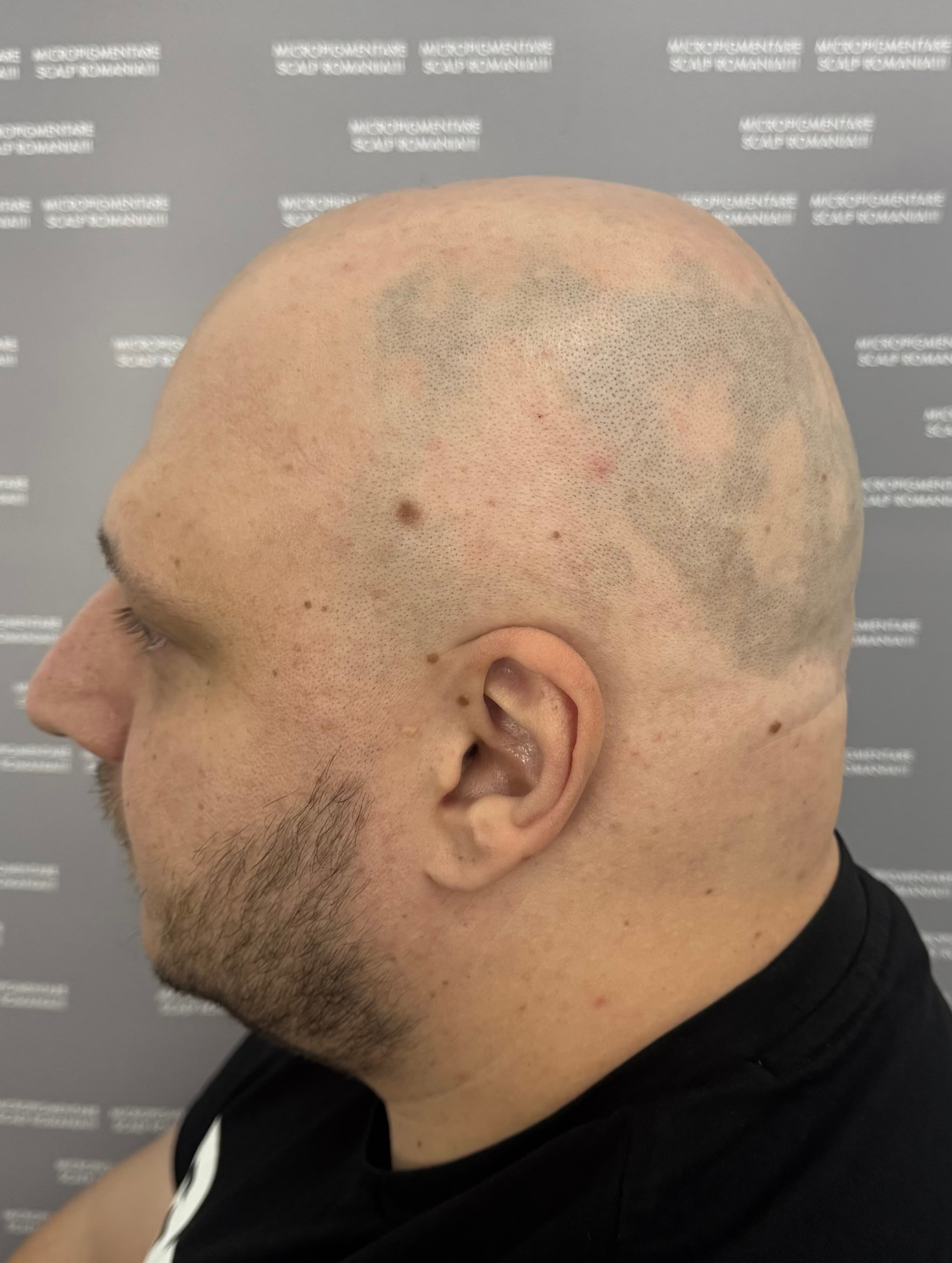 Înainte de micropigmentare scalp - Alopecie Areată