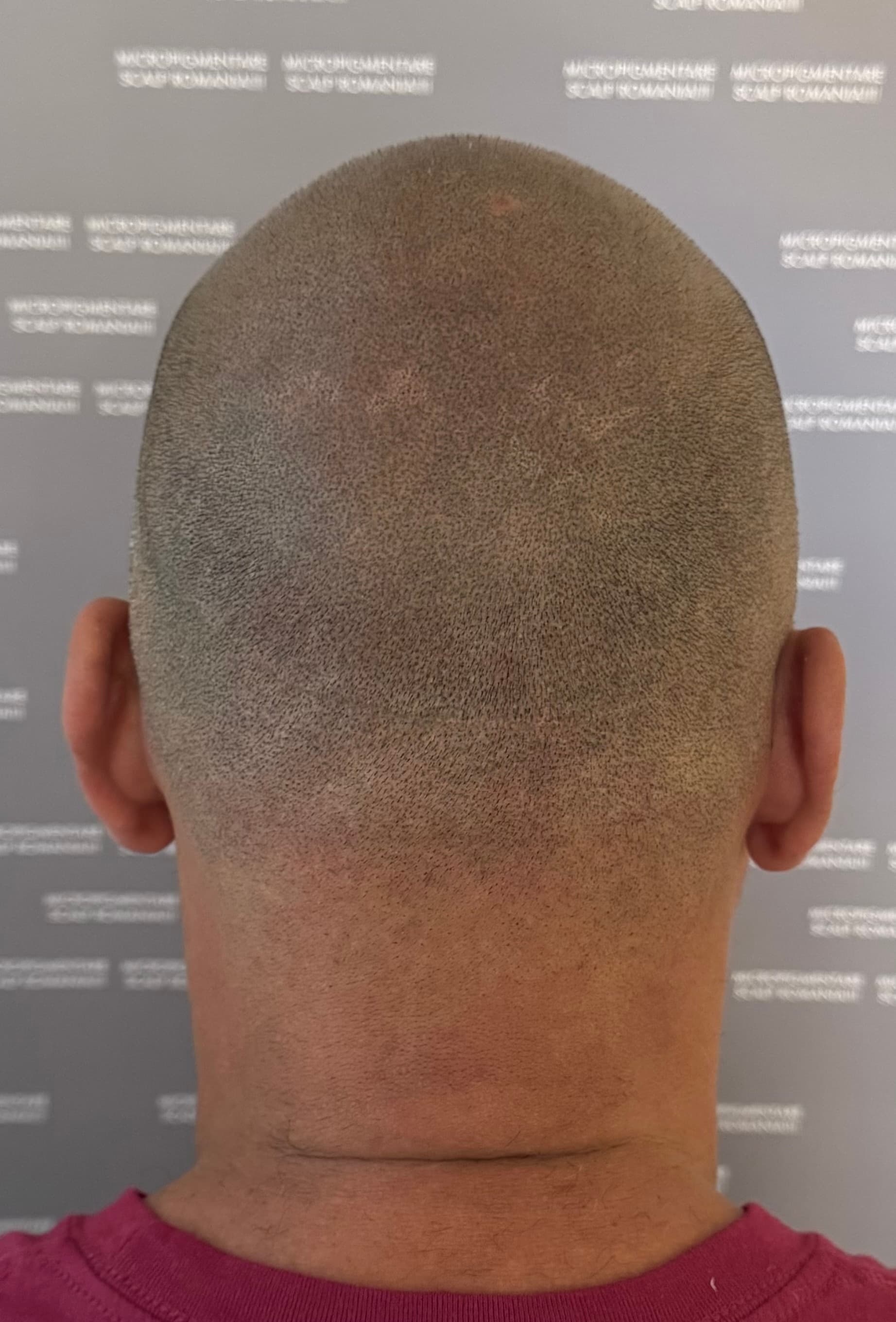 După micropigmentare scalp - Reparare Cicatrici
