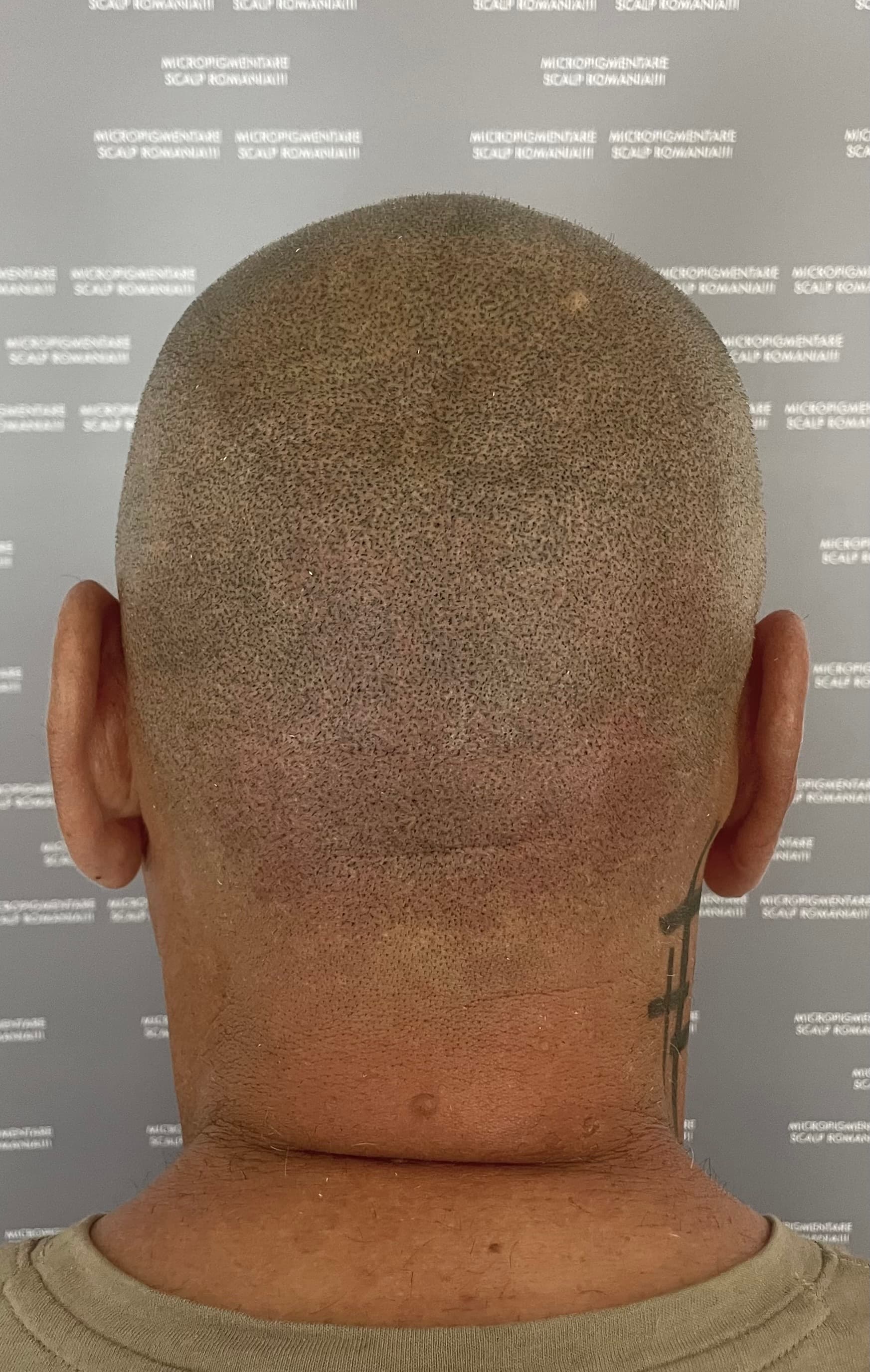 După micropigmentare scalp - Reparare Cicatrici