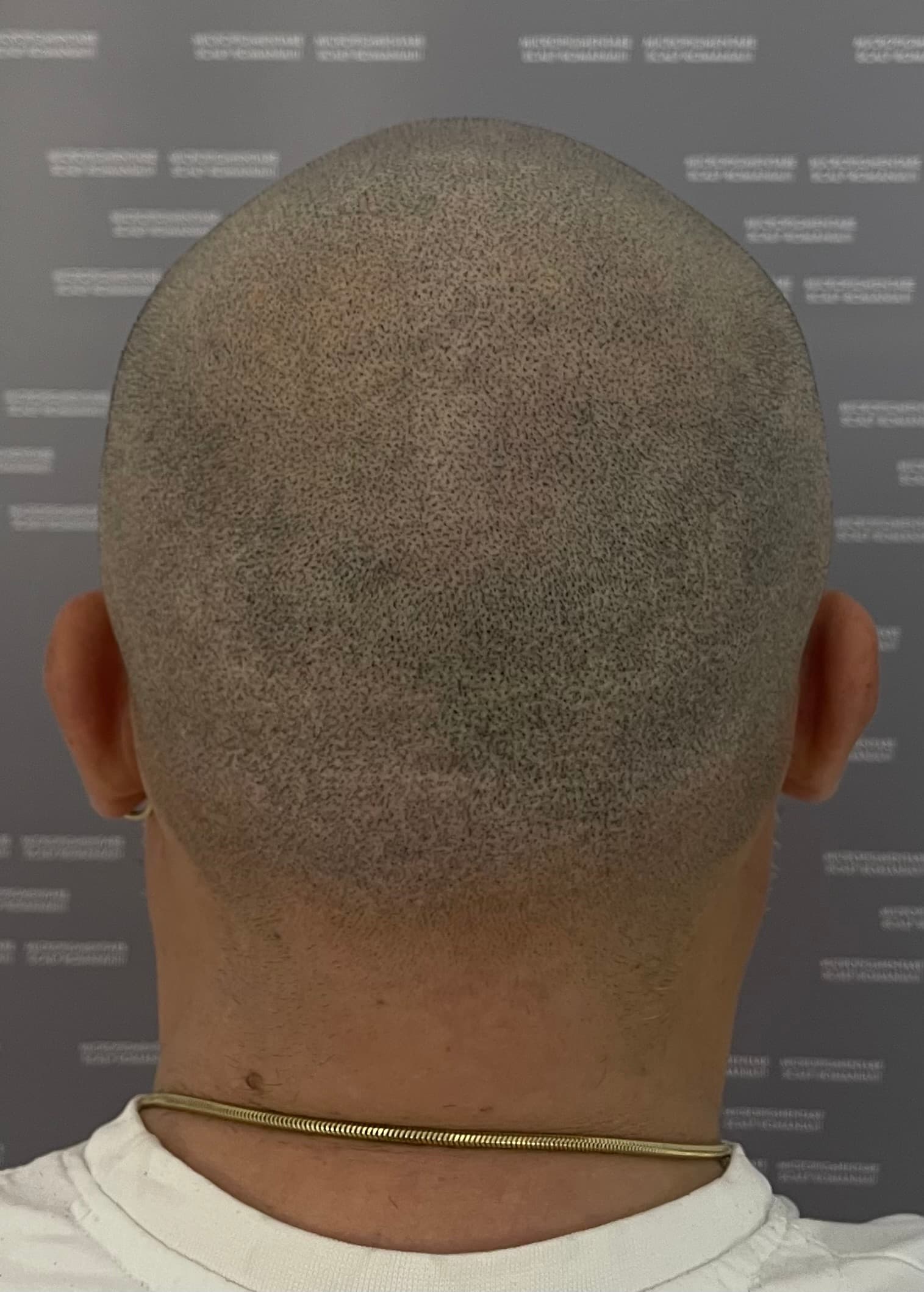 După micropigmentare scalp - Reparare Cicatrici