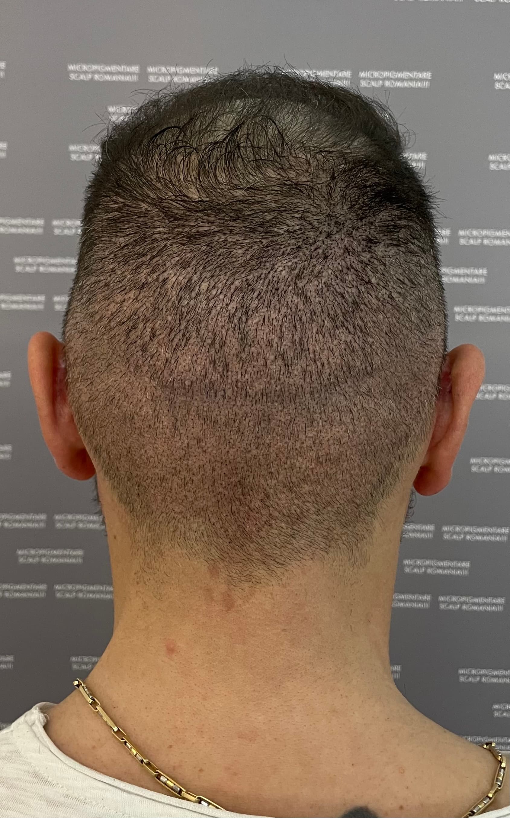După micropigmentare scalp - Reparare Cicatrici