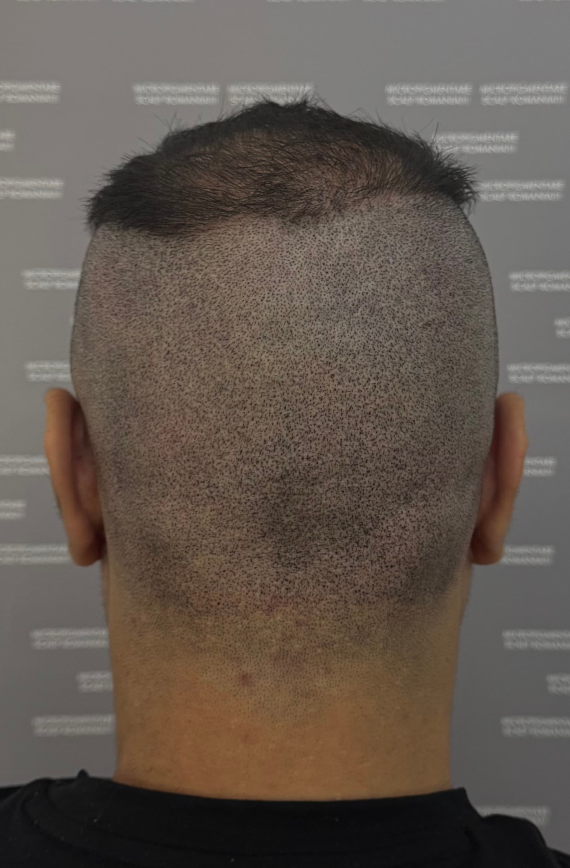 După micropigmentare scalp - Reparare Cicatrici