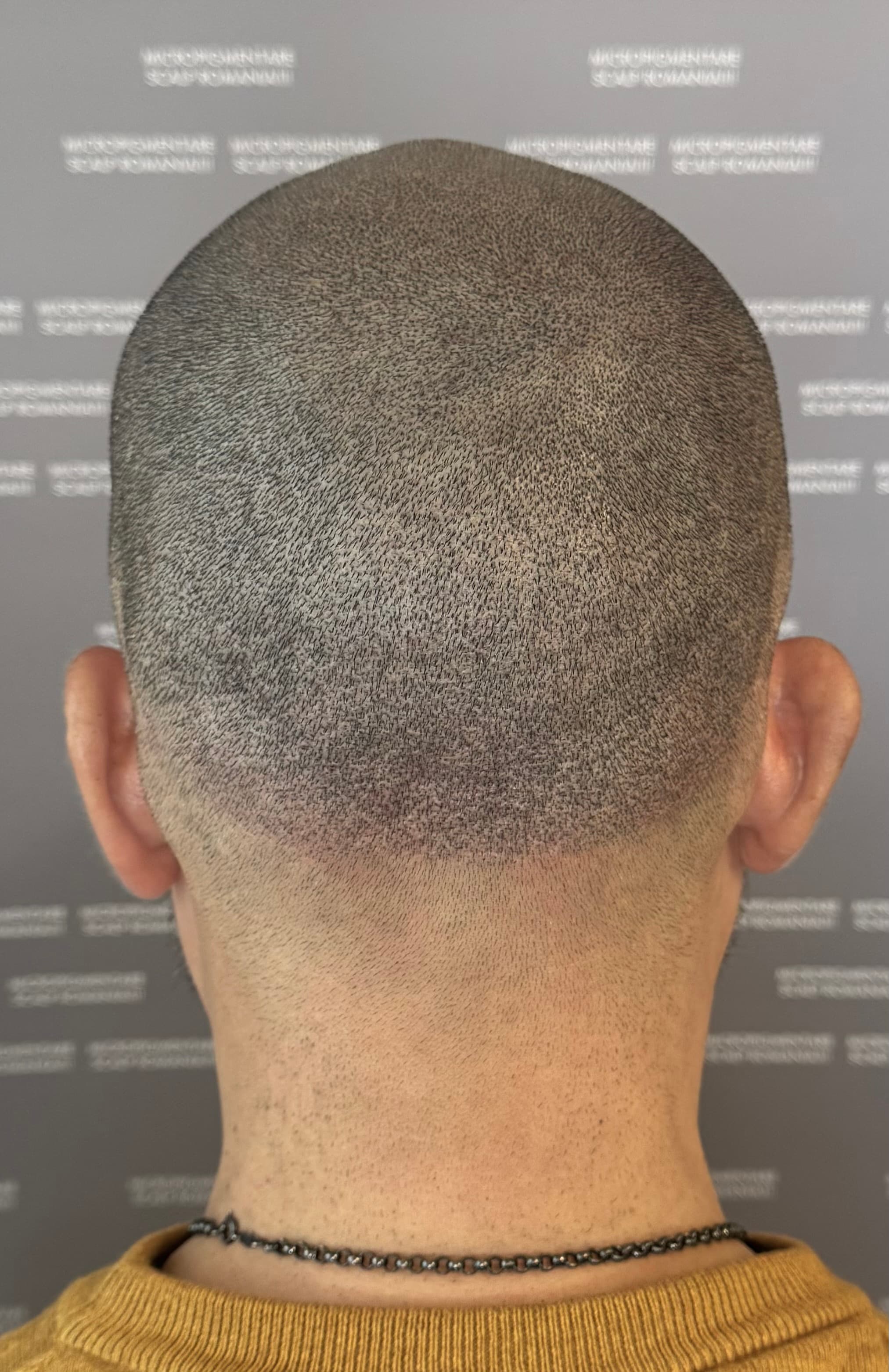 După micropigmentare scalp - Reparare Cicatrici