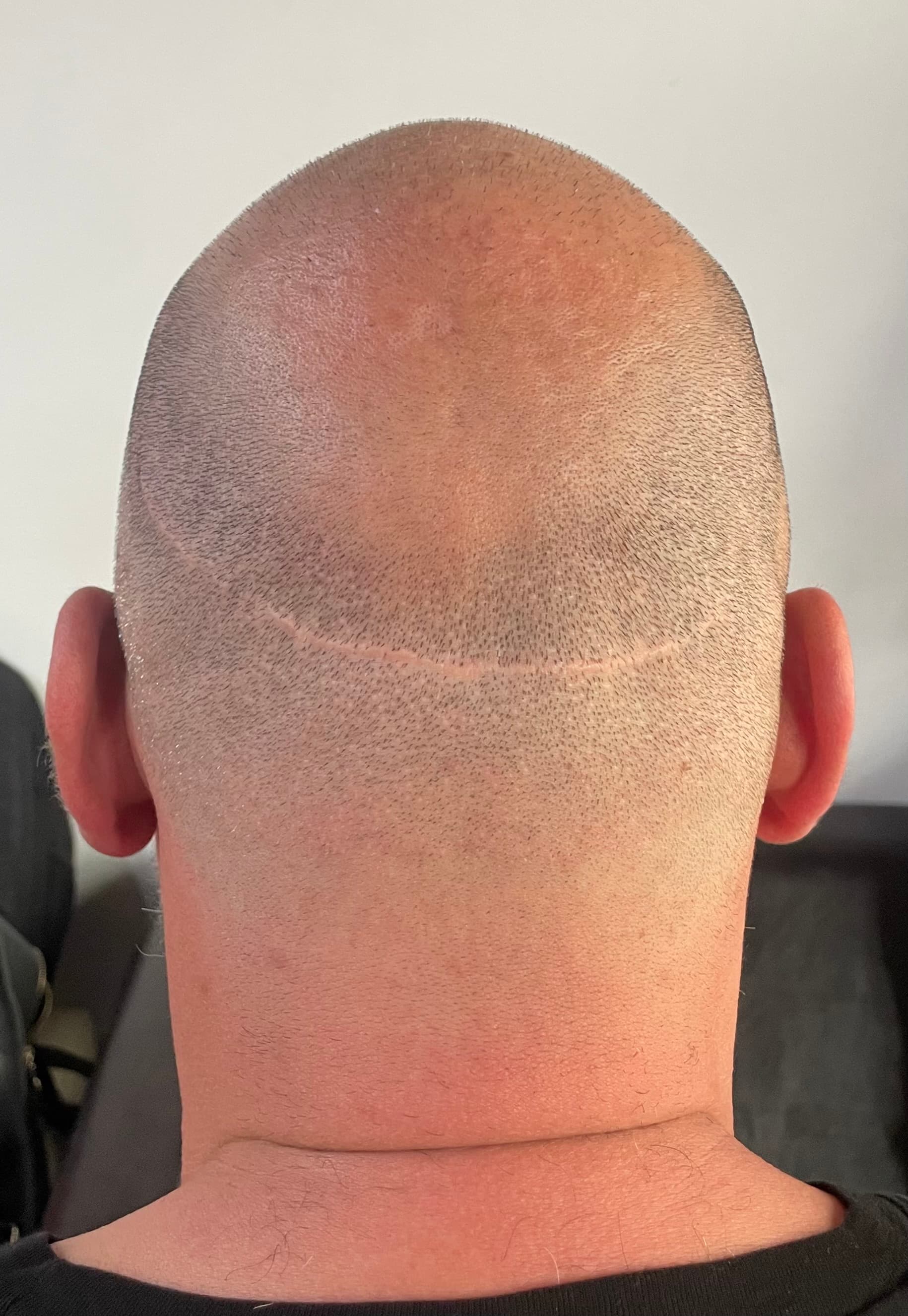 Înainte de micropigmentare scalp - Reparare Cicatrici