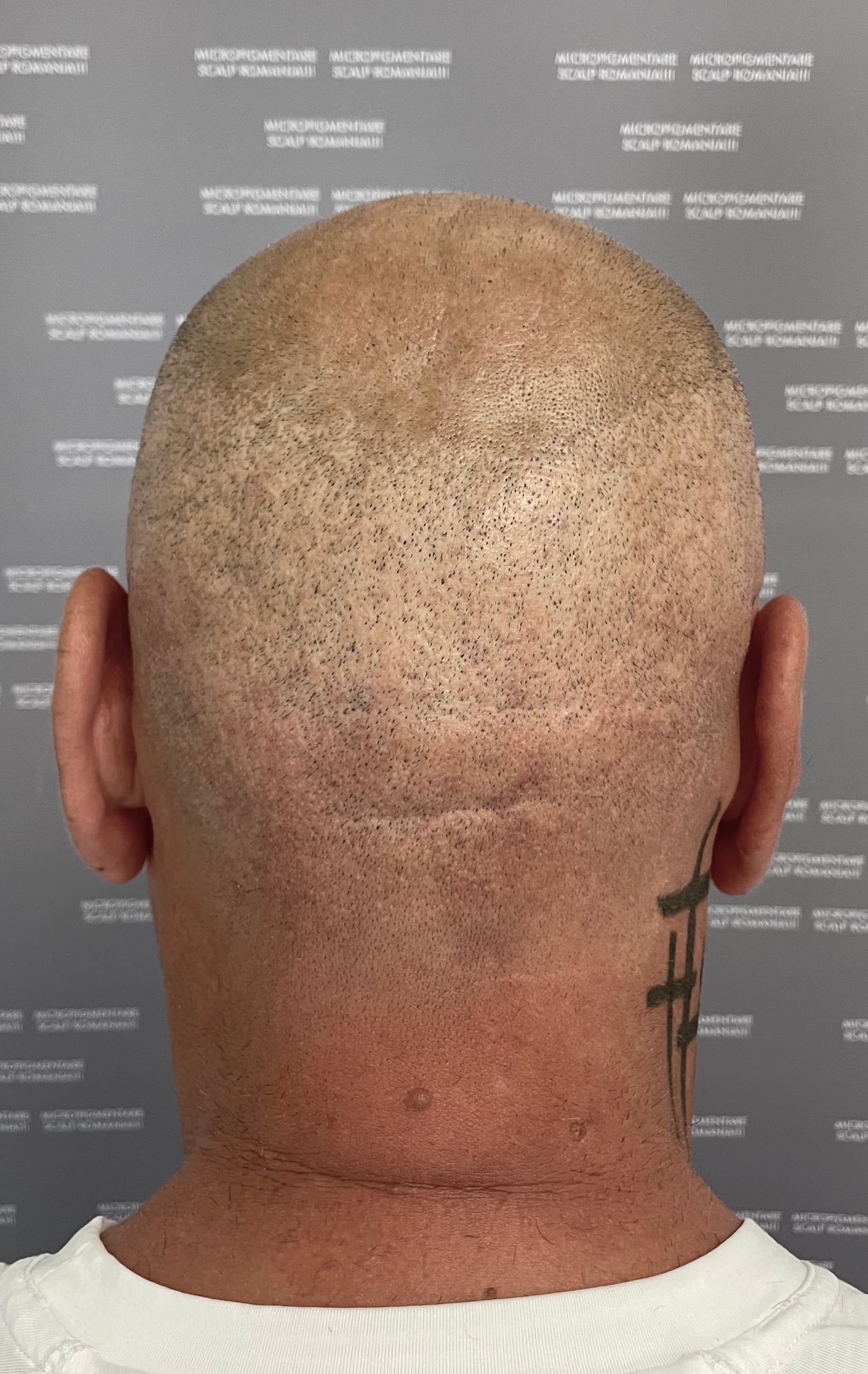 Înainte de micropigmentare scalp - Reparare Cicatrici