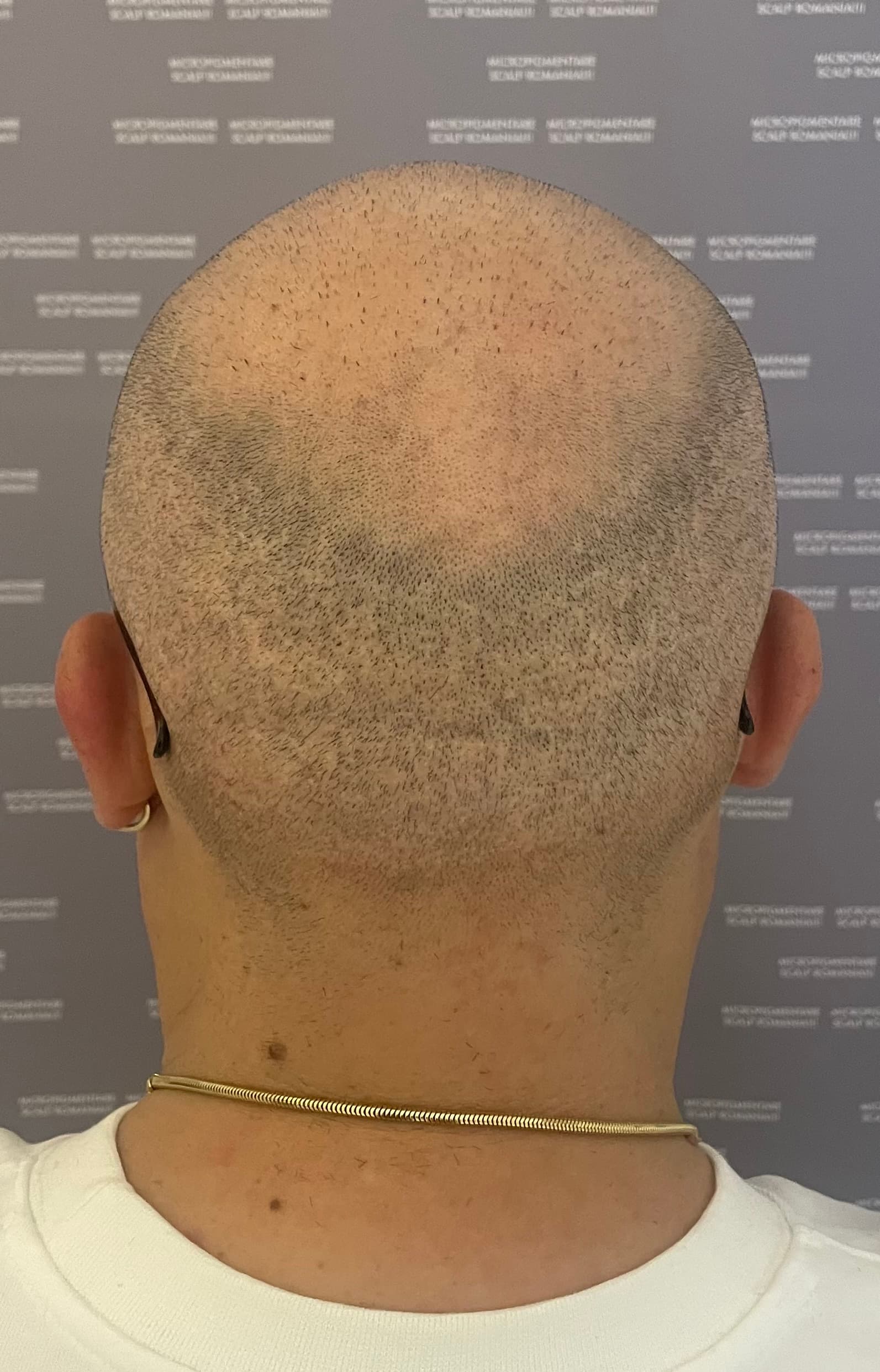 Înainte de micropigmentare scalp - Reparare Cicatrici