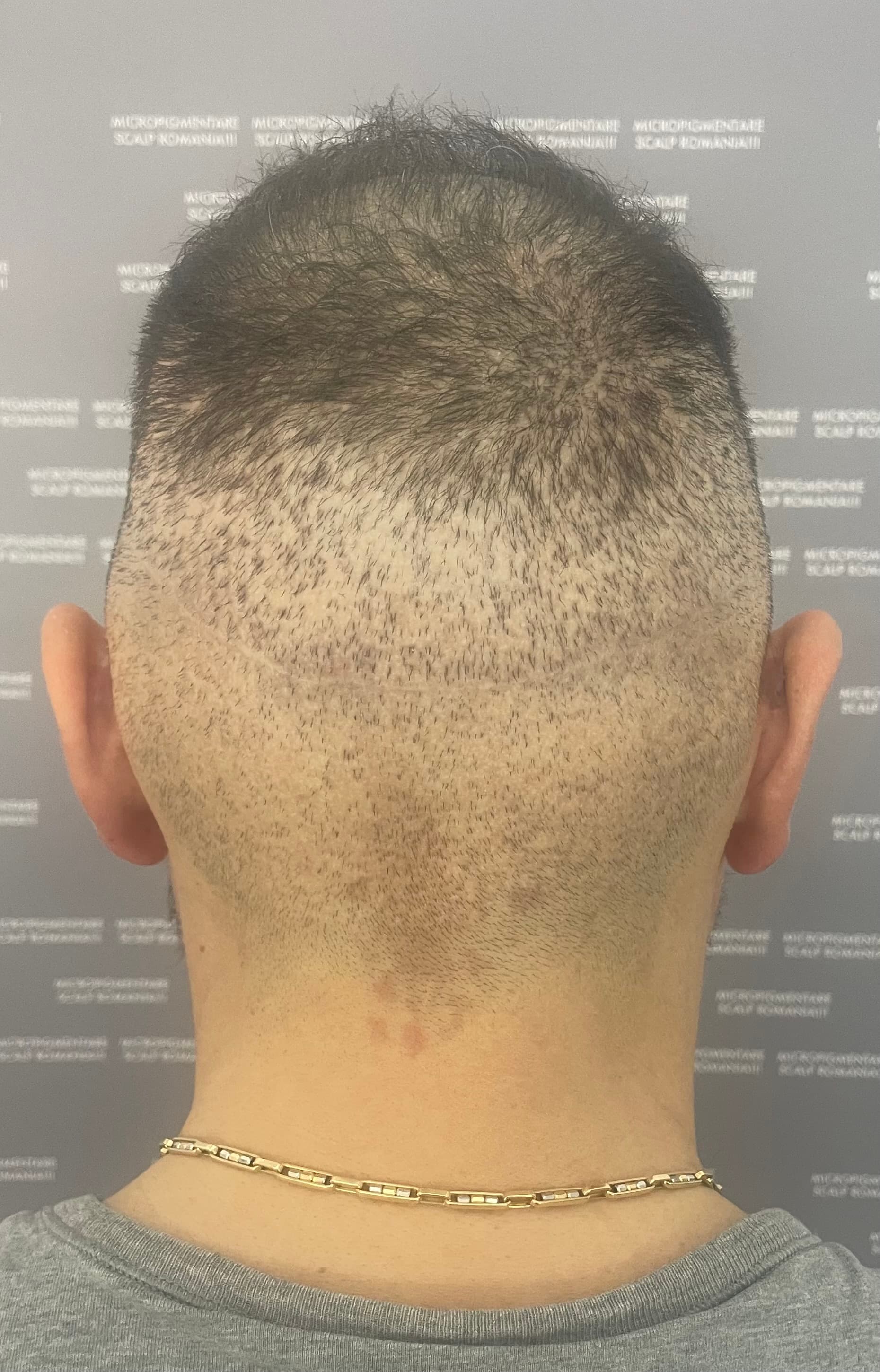 Înainte de micropigmentare scalp - Reparare Cicatrici