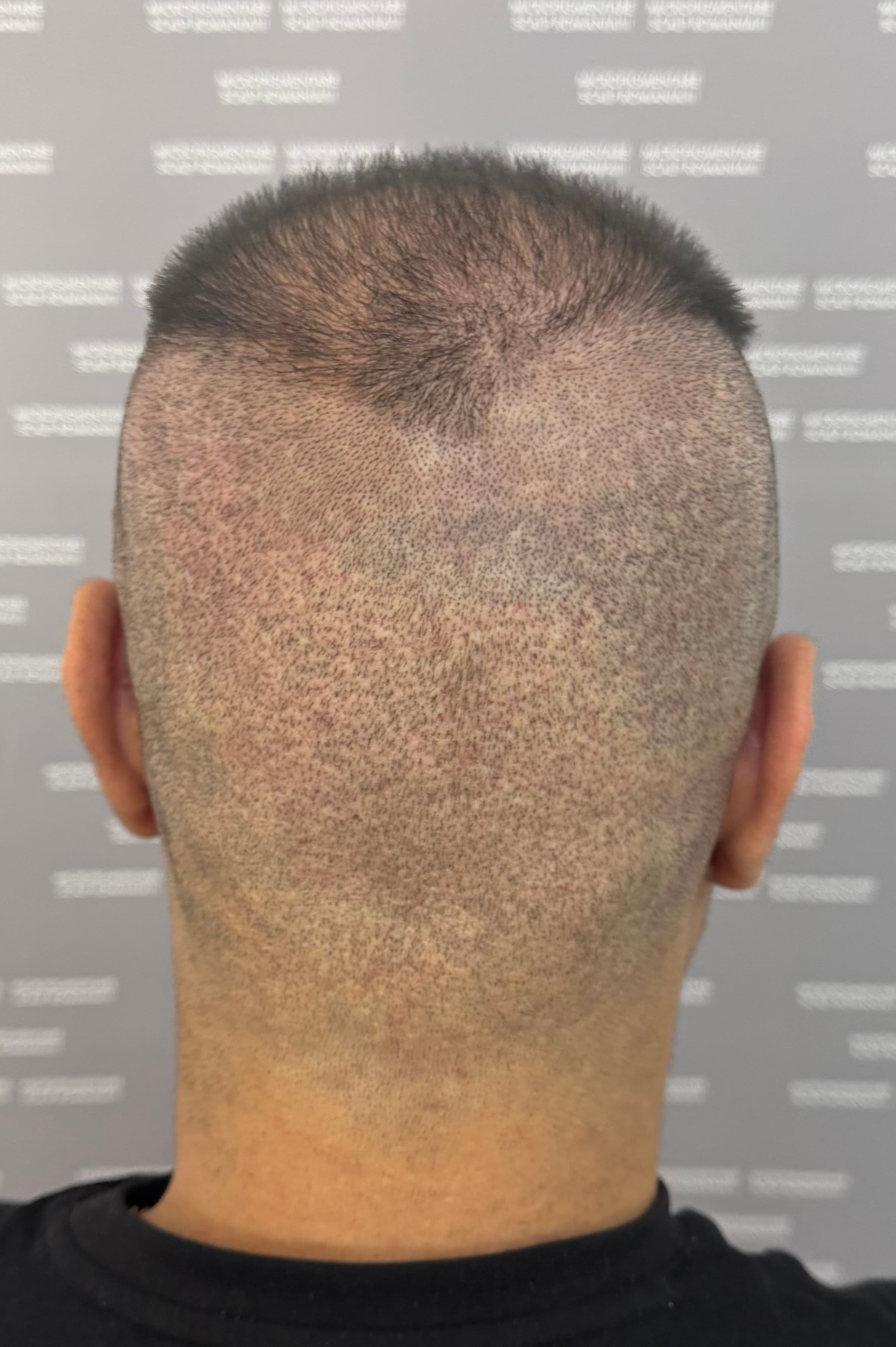 Înainte de micropigmentare scalp - Reparare Cicatrici