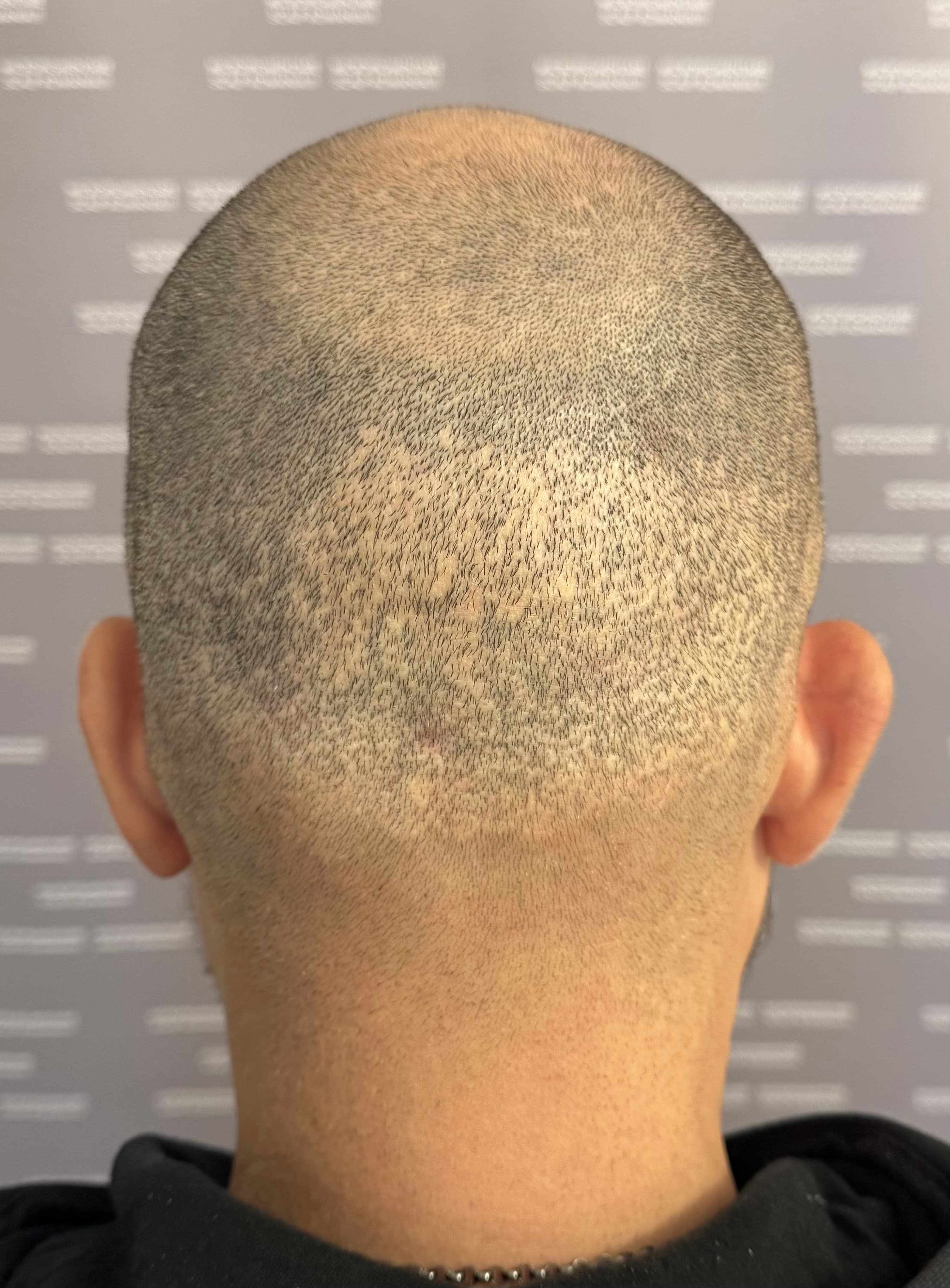 Înainte de micropigmentare scalp - Reparare Cicatrici