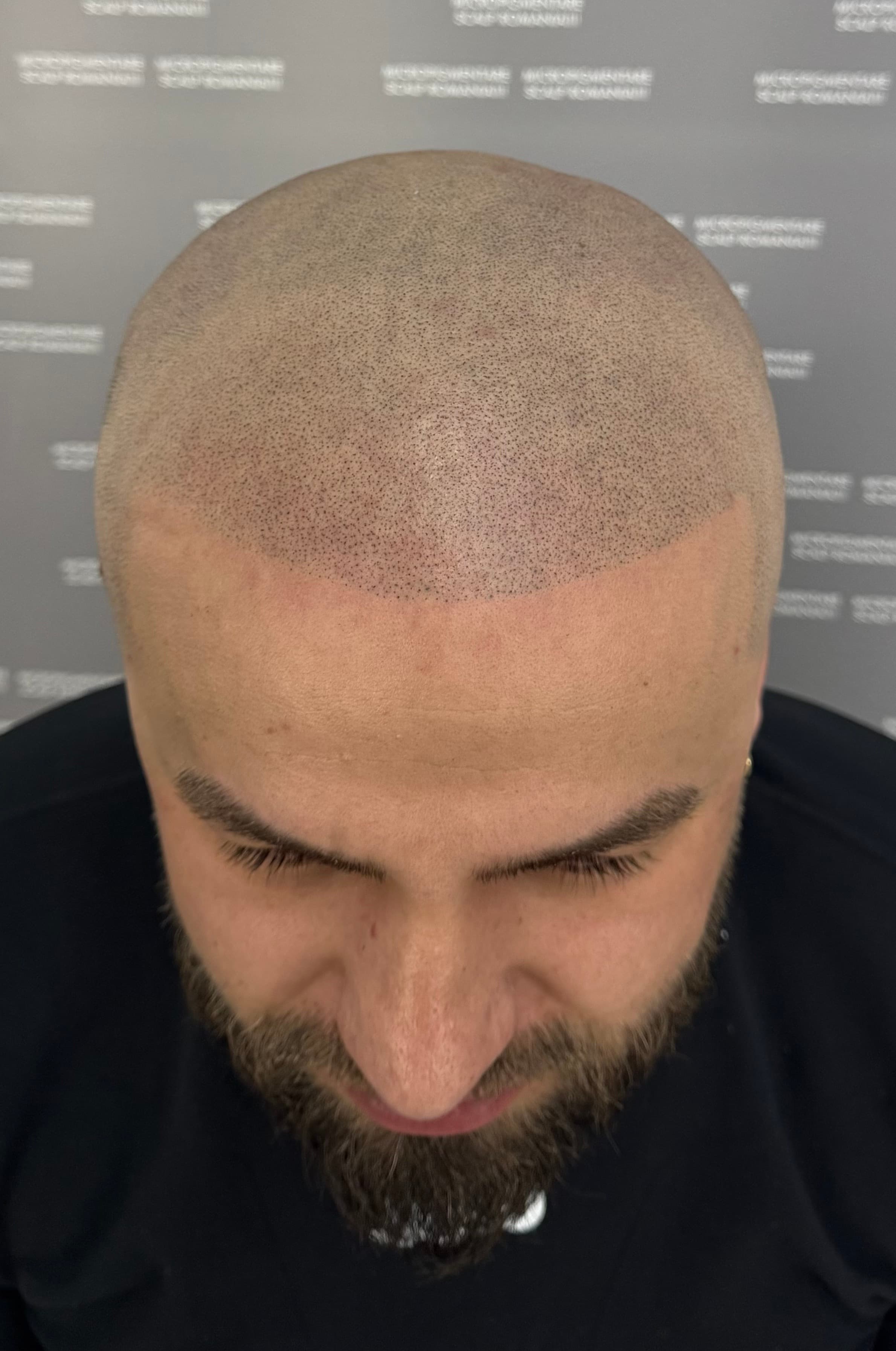 După micropigmentare scalp - Corecții SMP