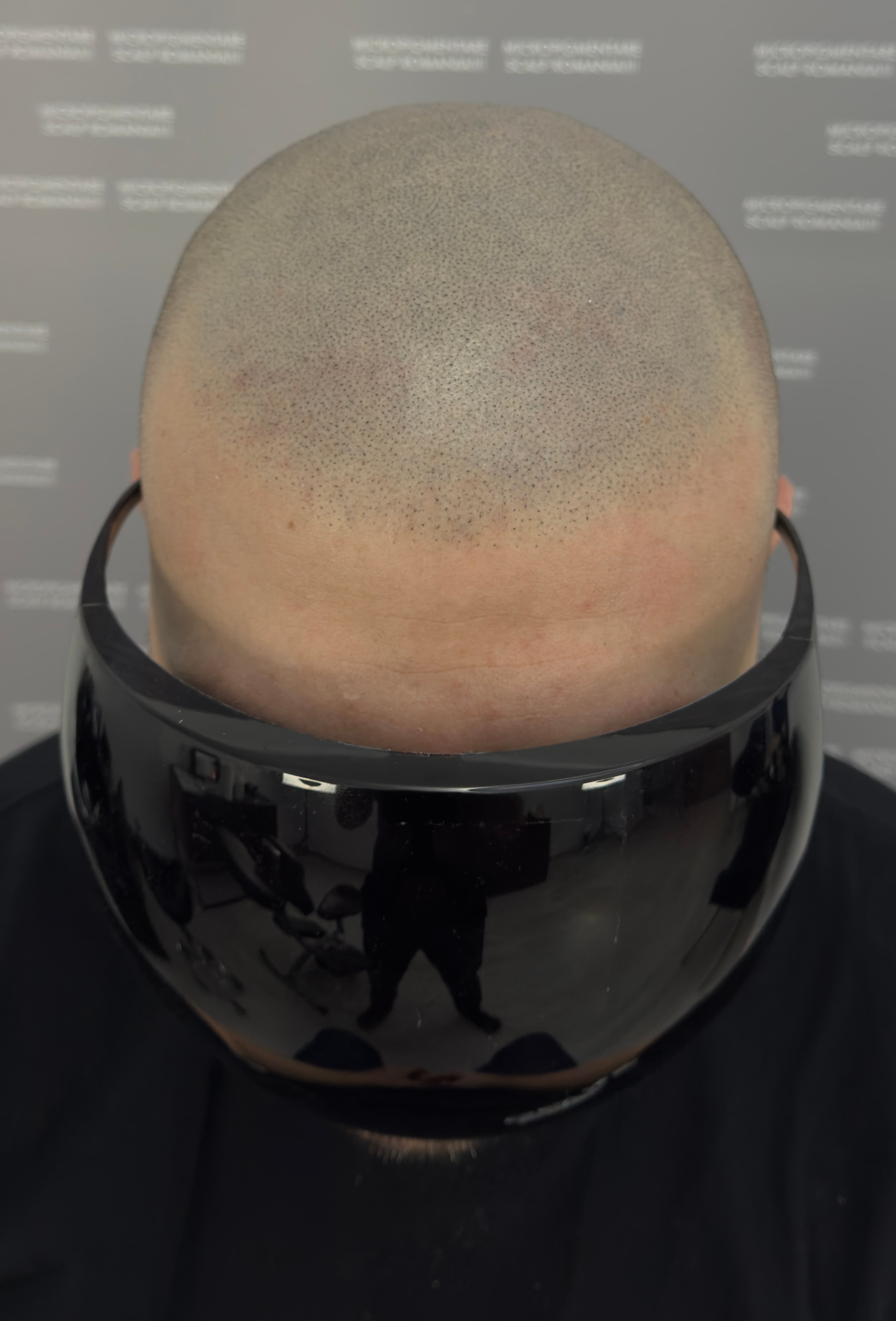 După micropigmentare scalp - Corecții SMP