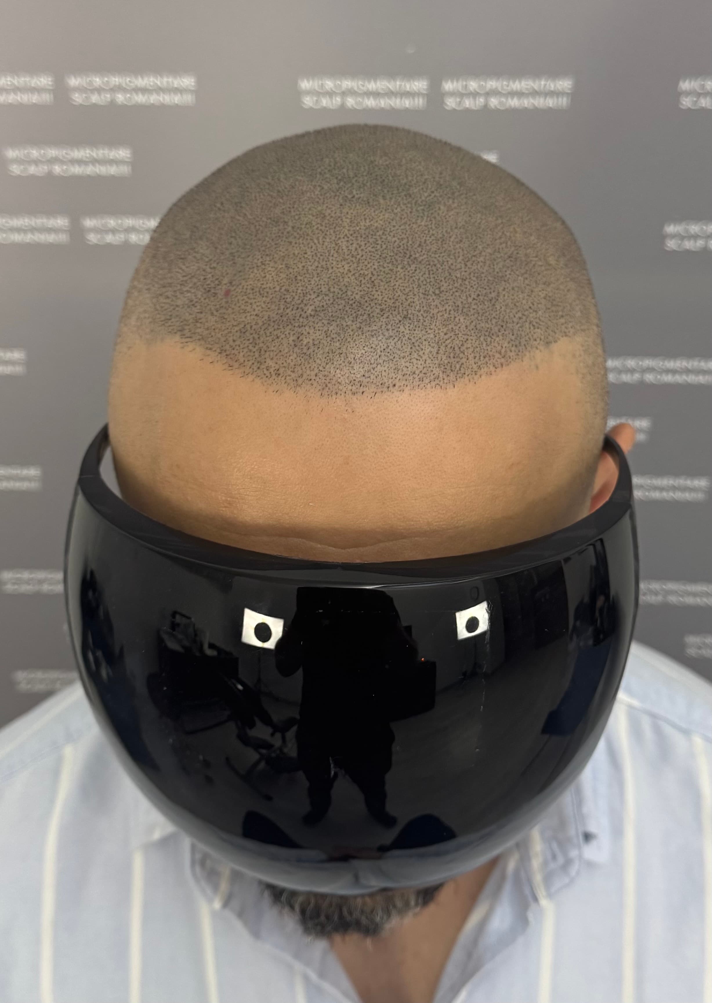După micropigmentare scalp - Corecții SMP