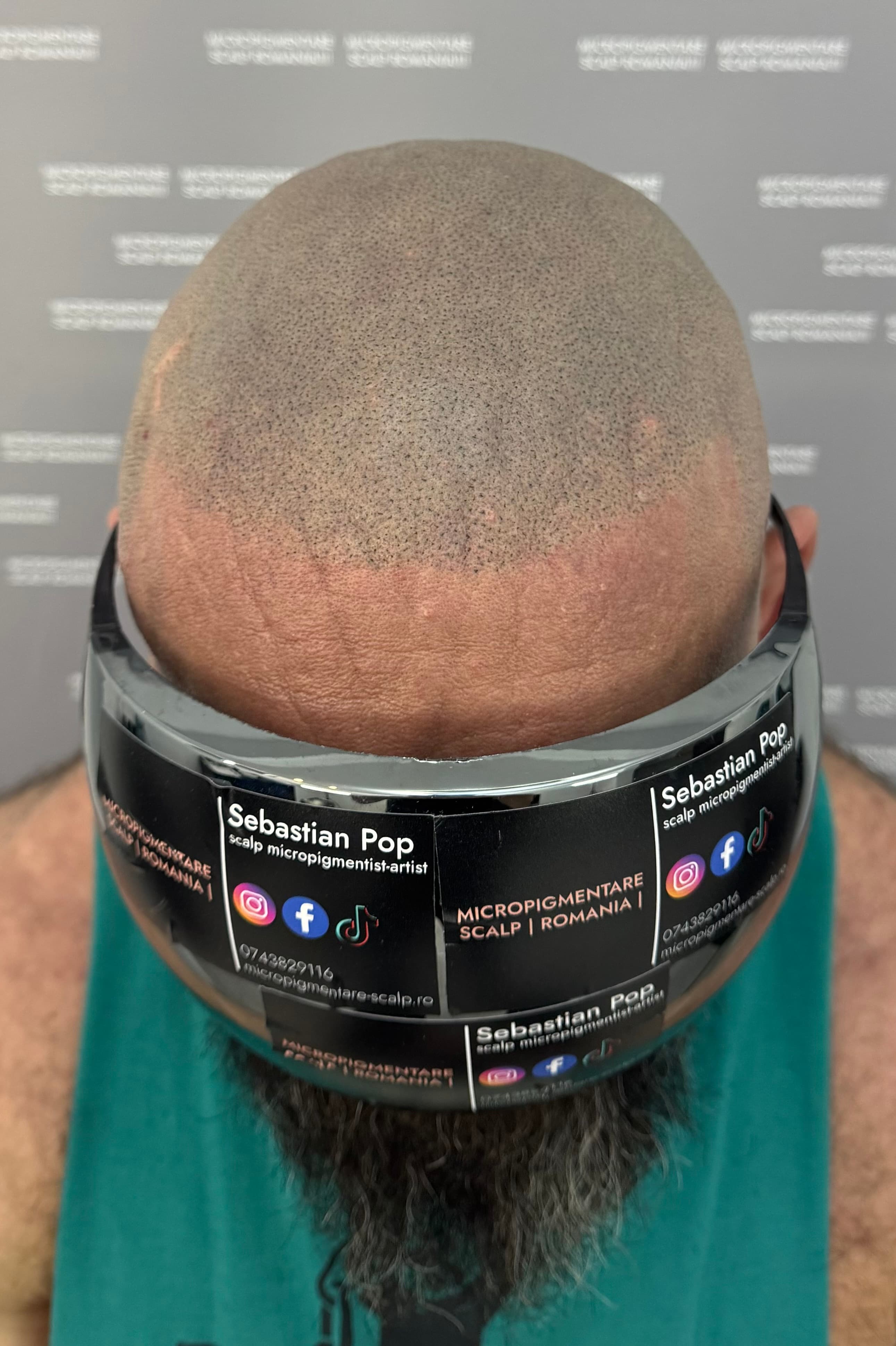 După micropigmentare scalp - Corecții SMP