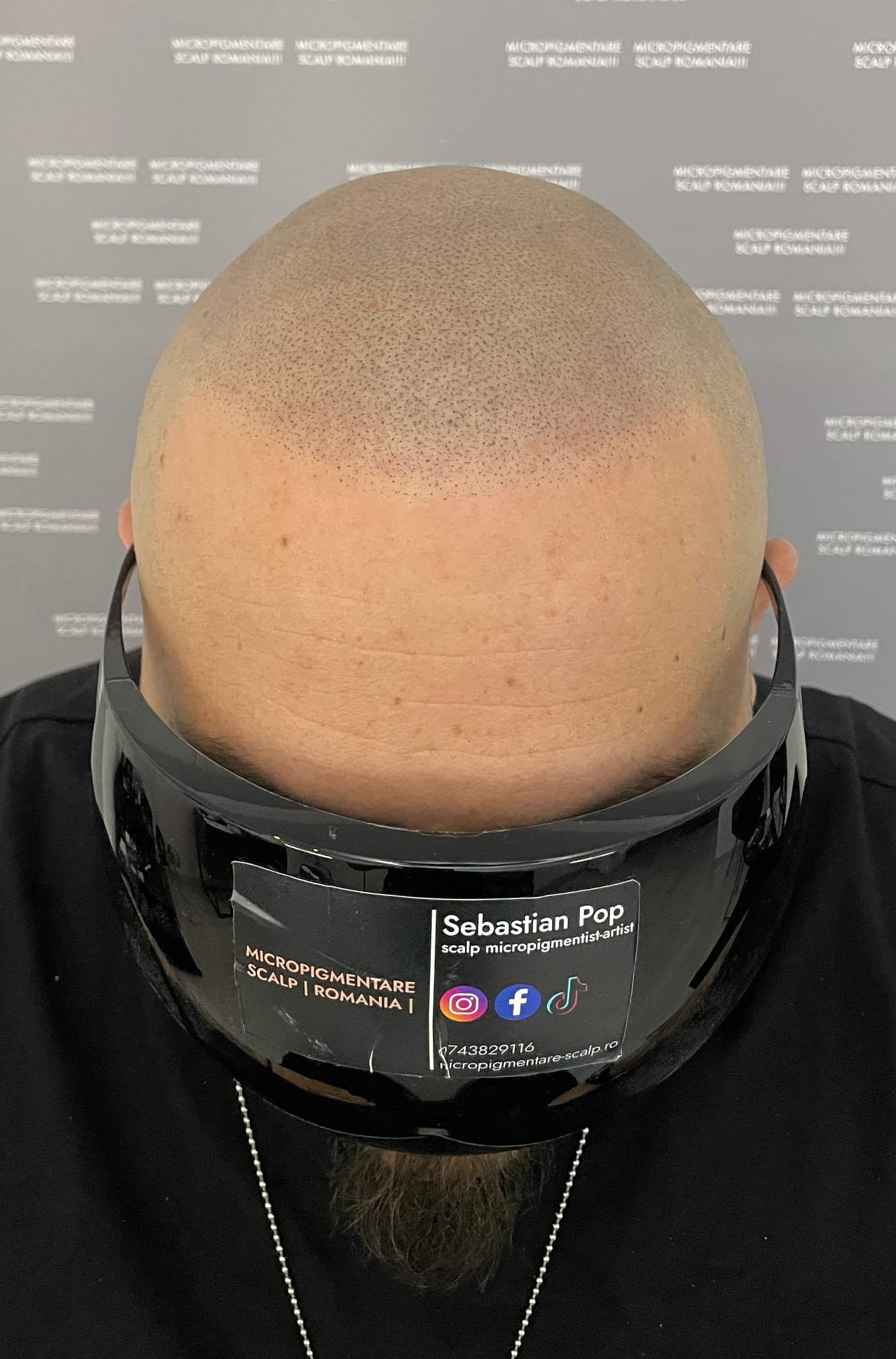 După micropigmentare scalp - Corecții SMP