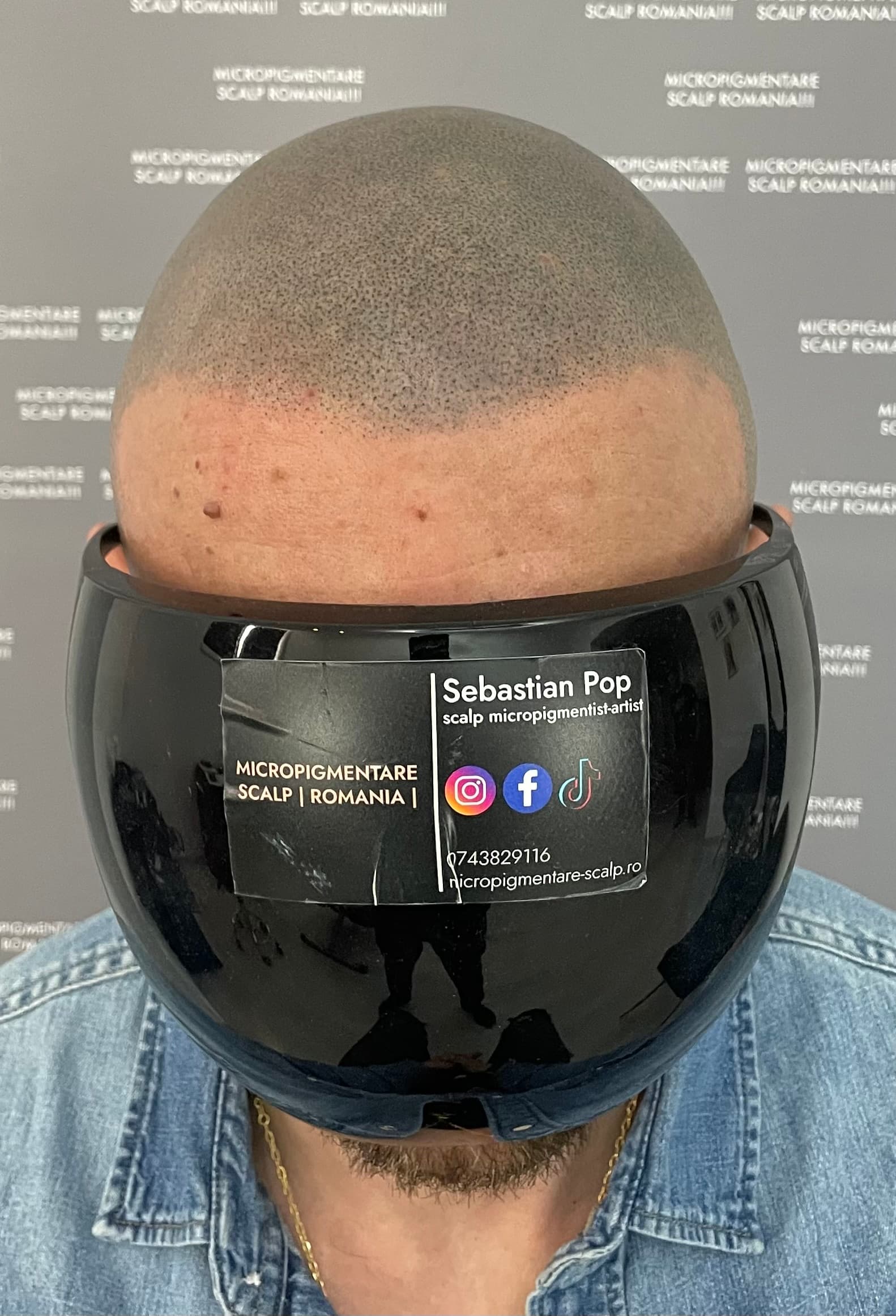 După micropigmentare scalp - Corecții SMP