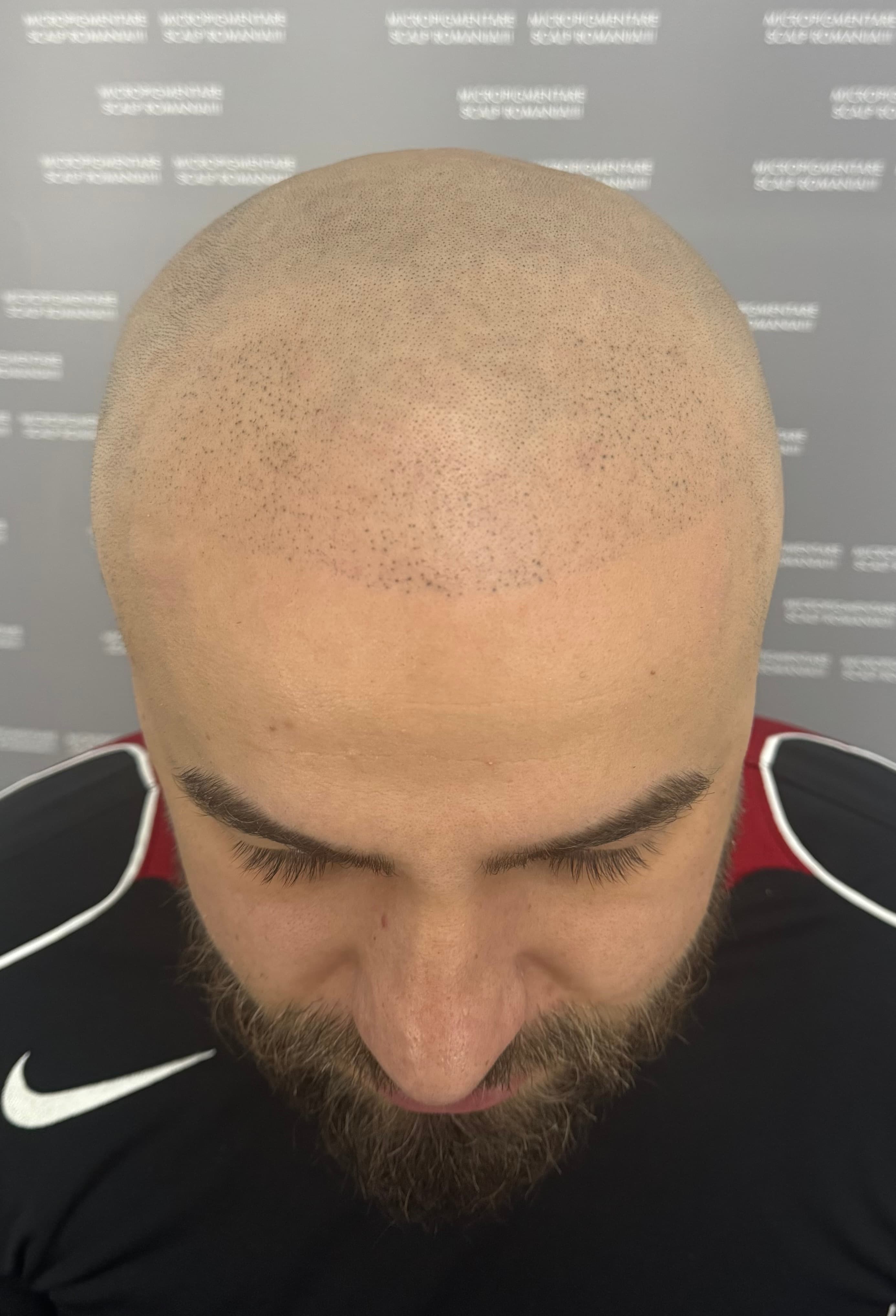 Înainte de micropigmentare scalp - Corecții SMP