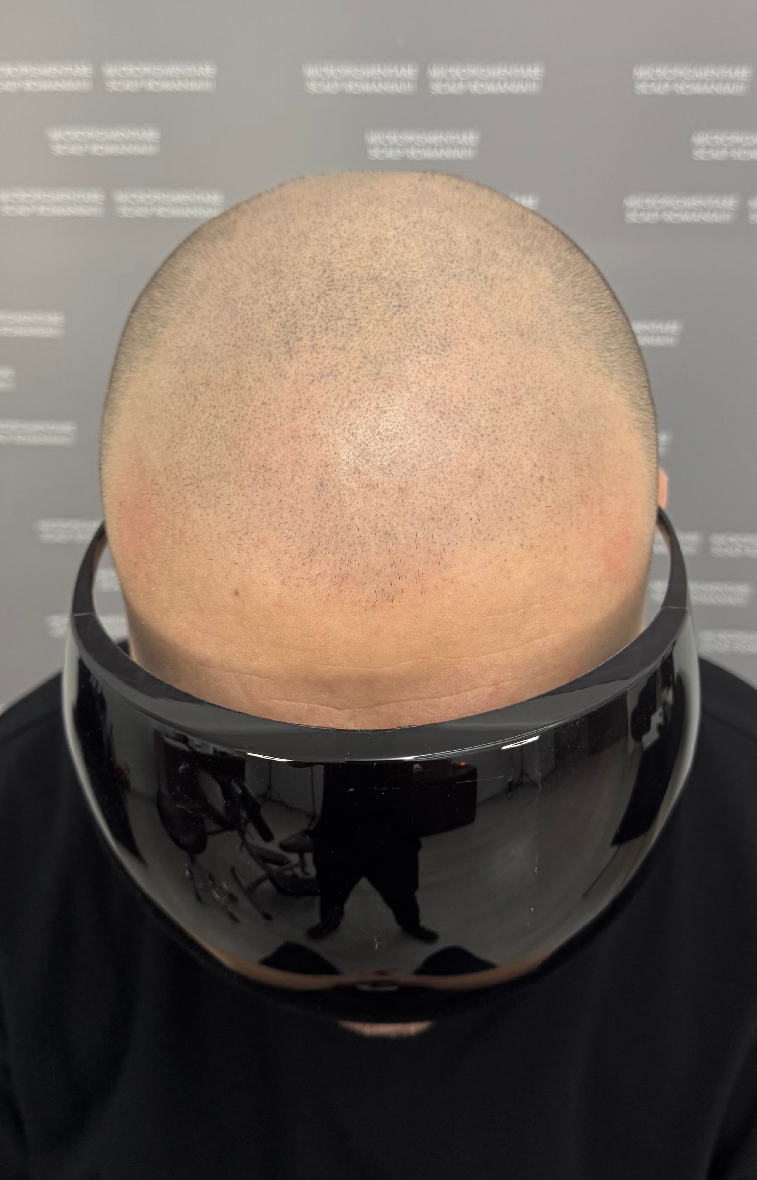 Înainte de micropigmentare scalp - Corecții SMP