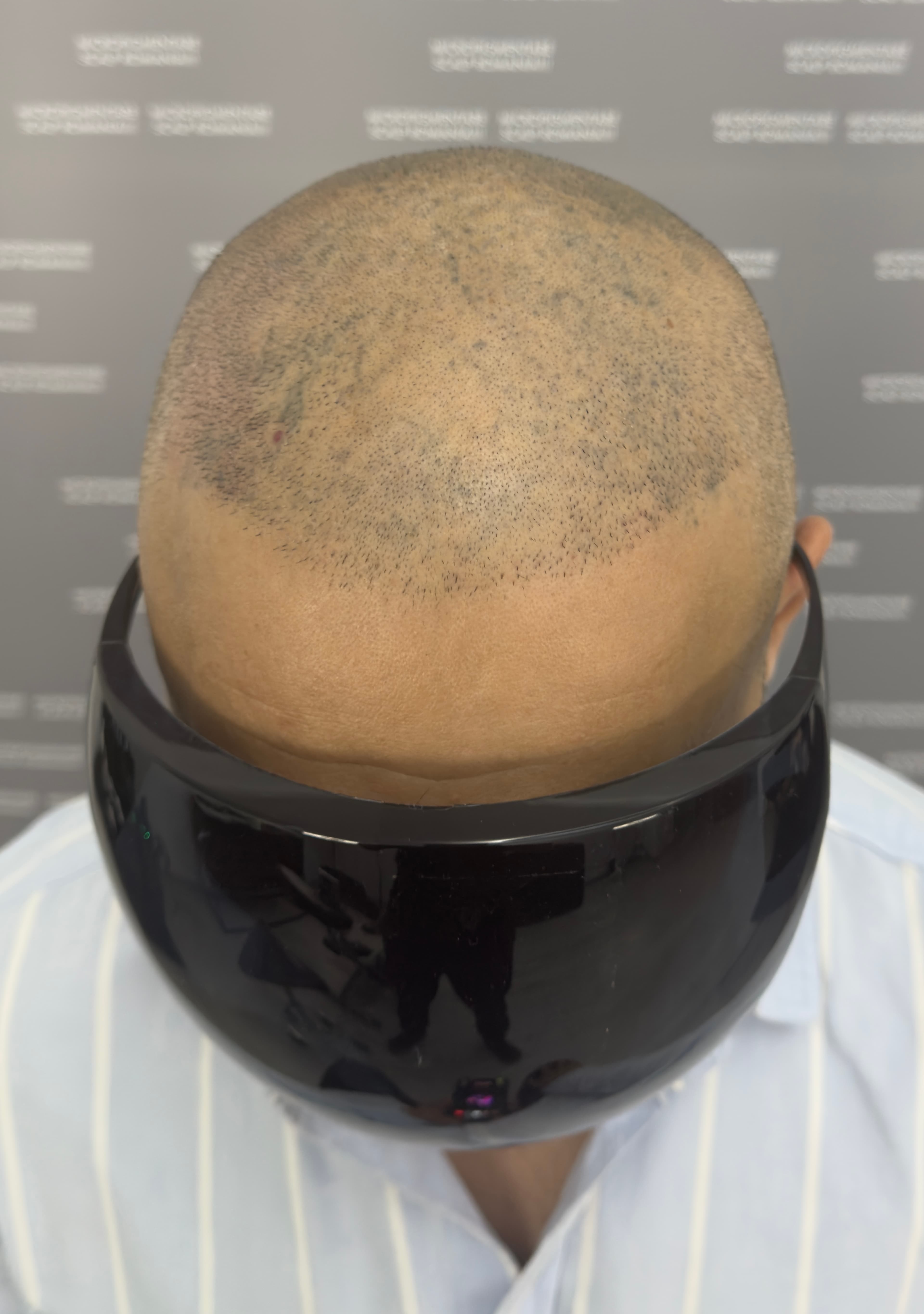 Înainte de micropigmentare scalp - Corecții SMP