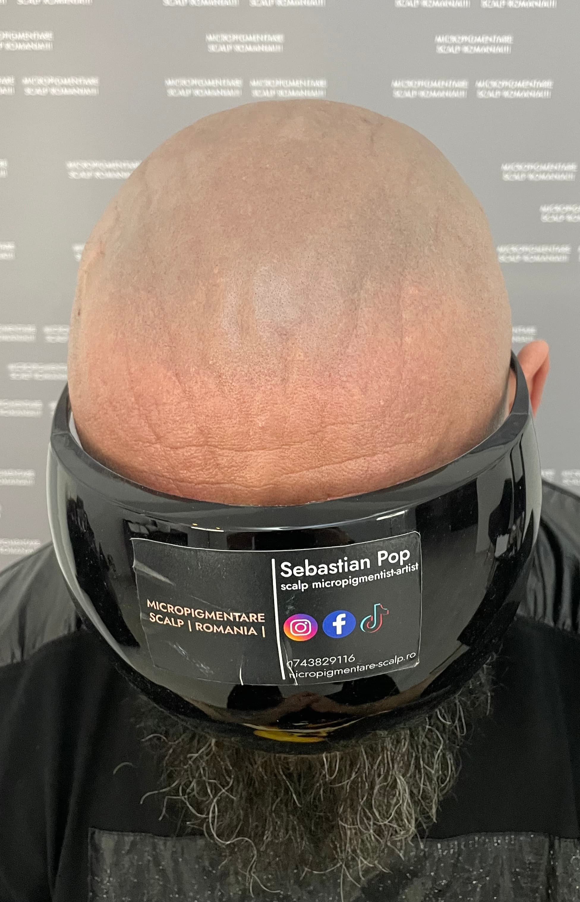 Înainte de micropigmentare scalp - Corecții SMP