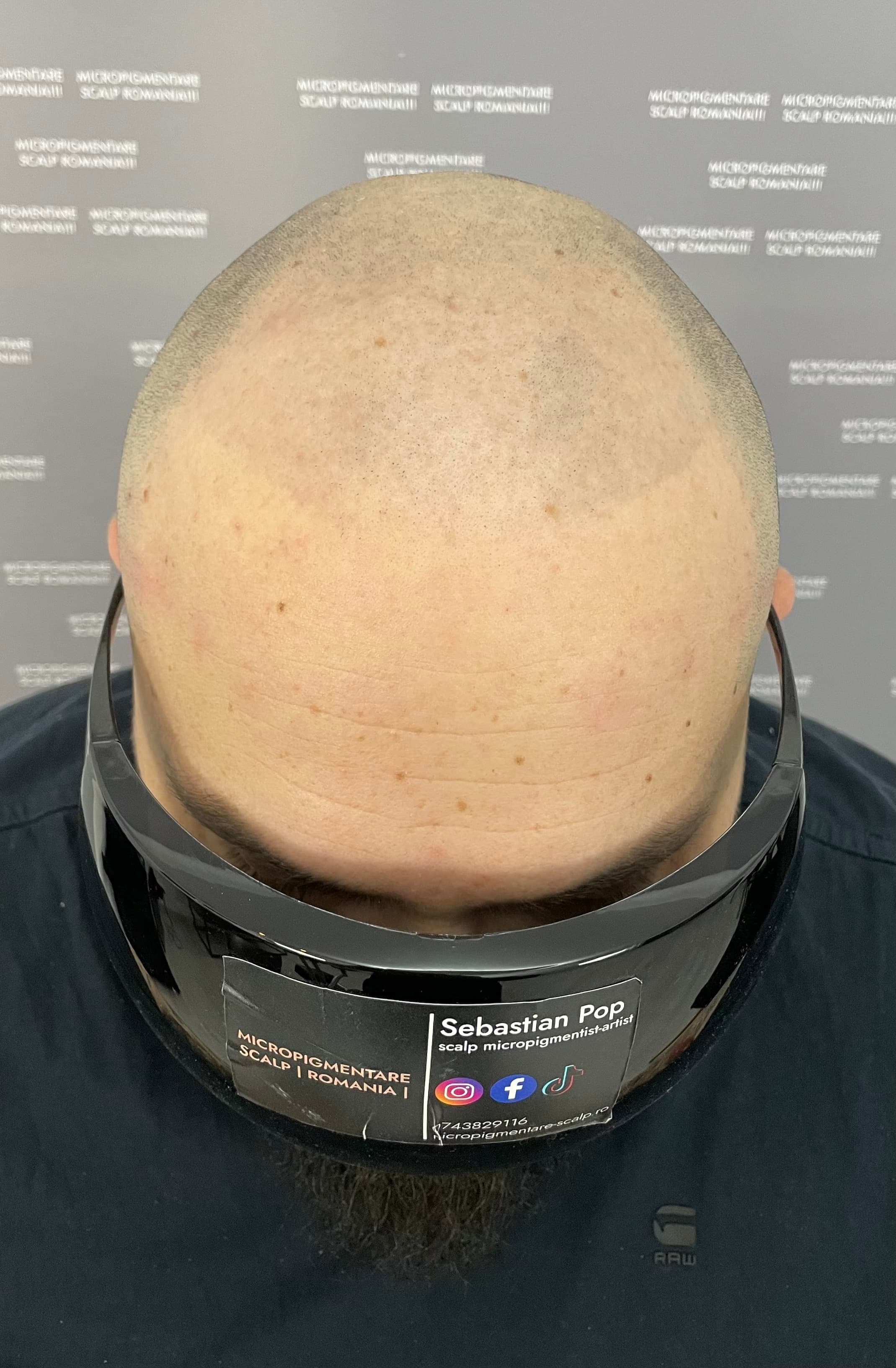 Înainte de micropigmentare scalp - Corecții SMP
