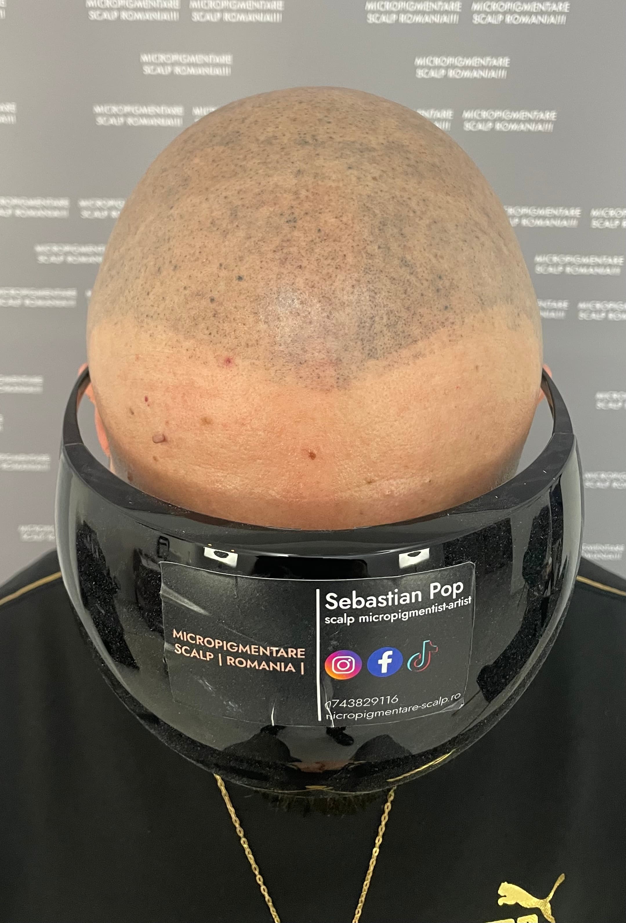 Înainte de micropigmentare scalp - Corecții SMP