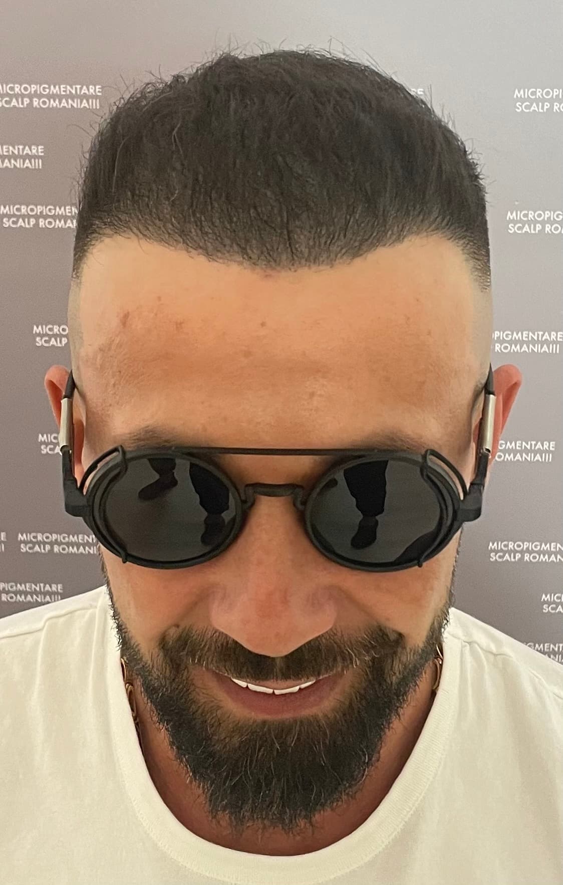 După micropigmentare scalp - Densitate Post Transplant