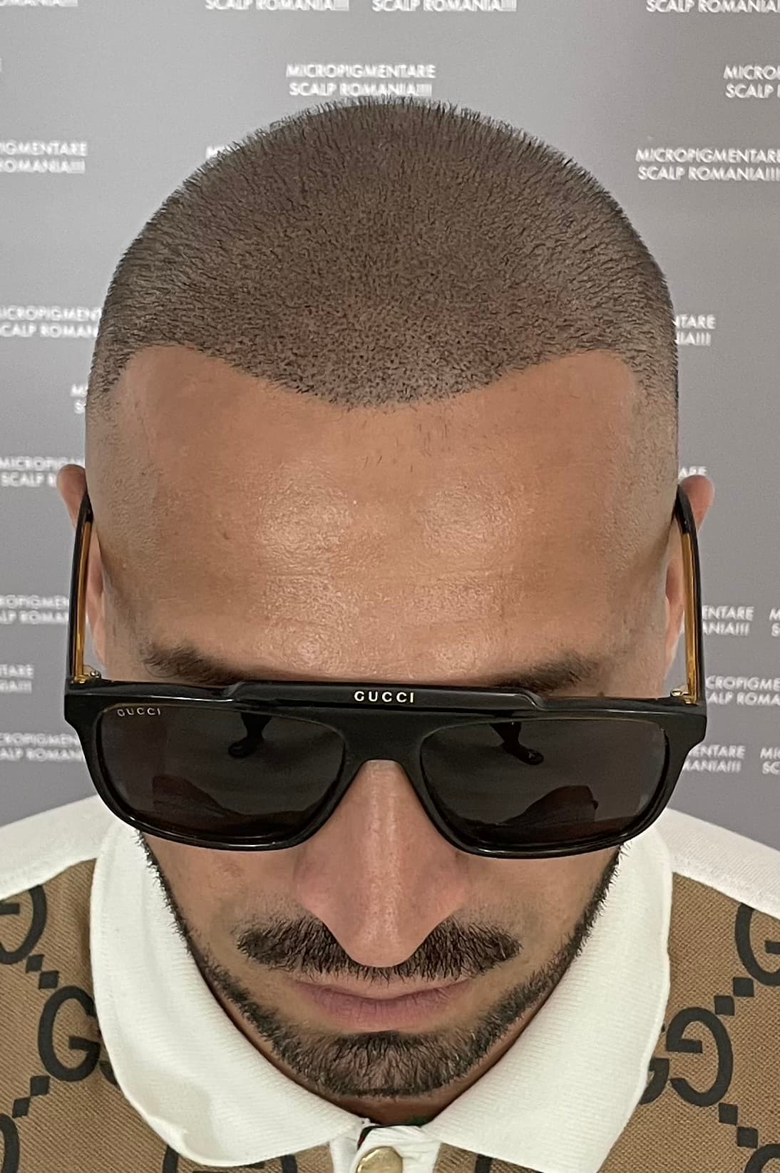 După micropigmentare scalp - Densitate Post Transplant