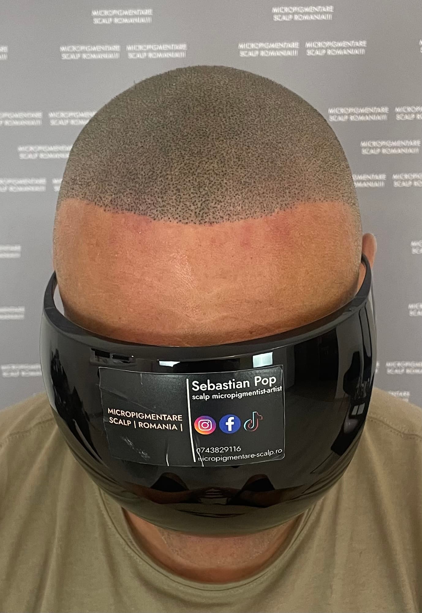 După micropigmentare scalp - Densitate Post Transplant