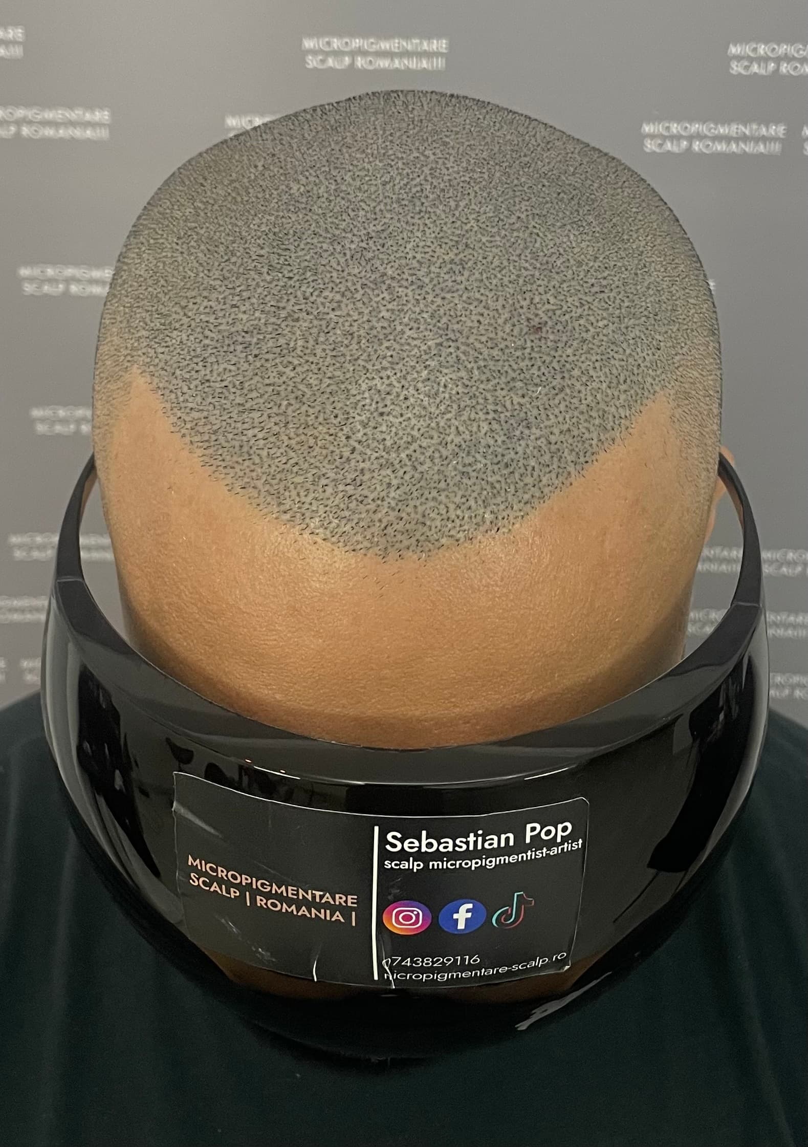 După micropigmentare scalp - Densitate Post Transplant