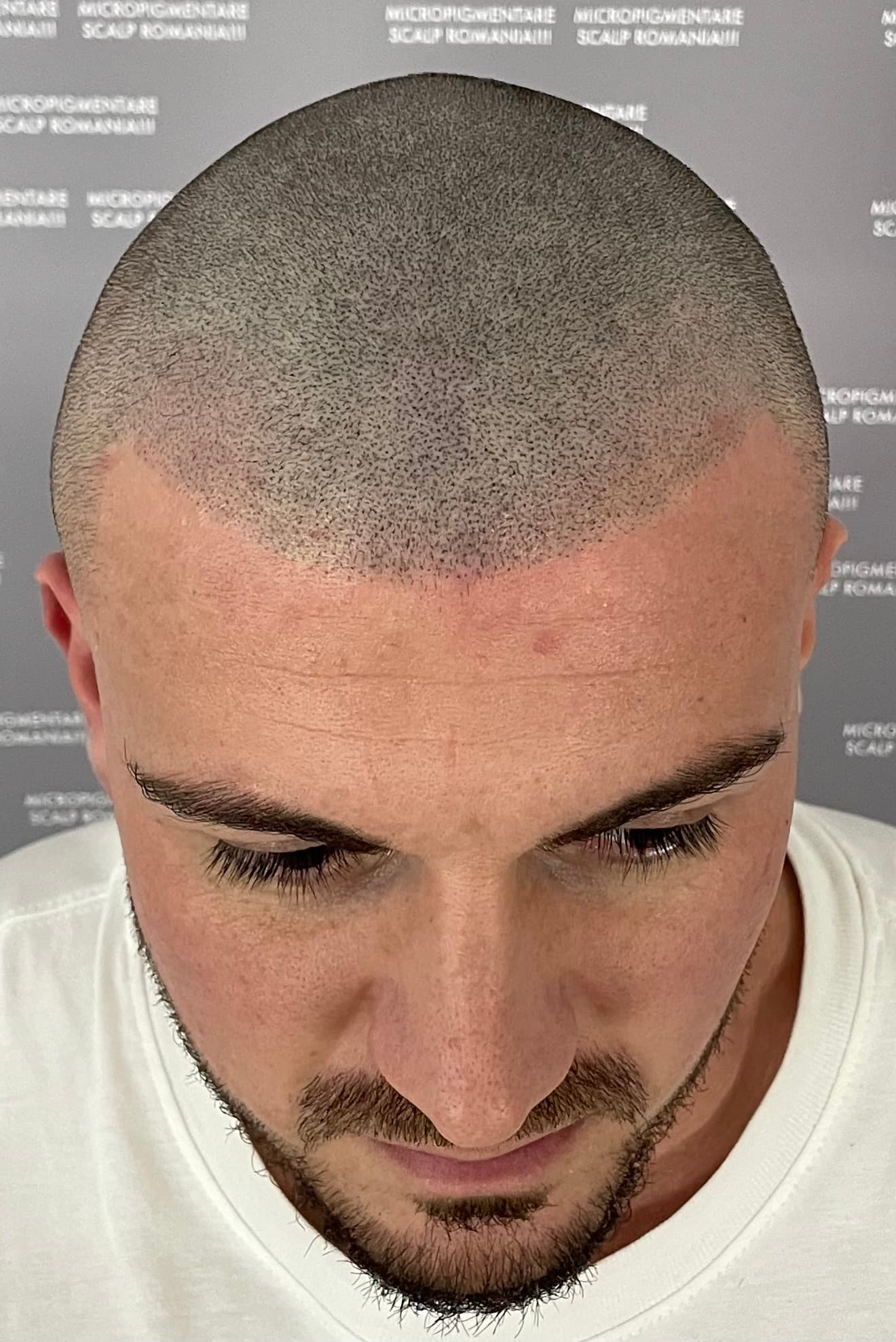 După micropigmentare scalp - Densitate Post Transplant