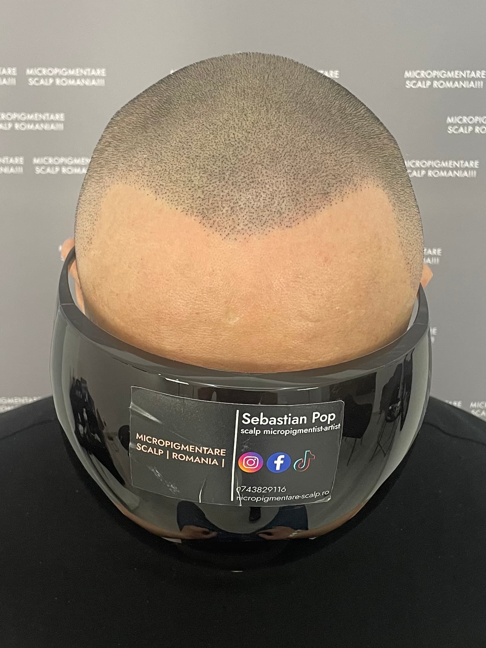 După micropigmentare scalp - Densitate Post Transplant