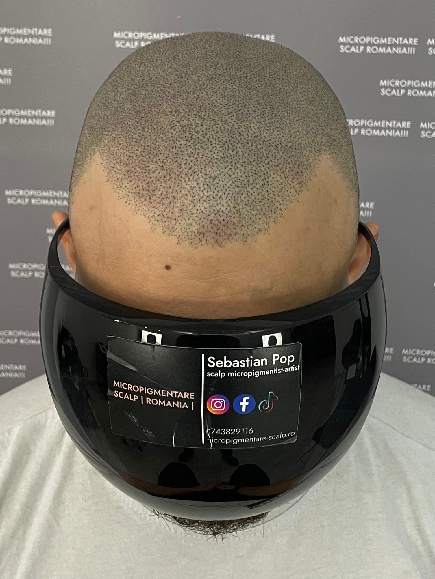 După micropigmentare scalp - Densitate Post Transplant
