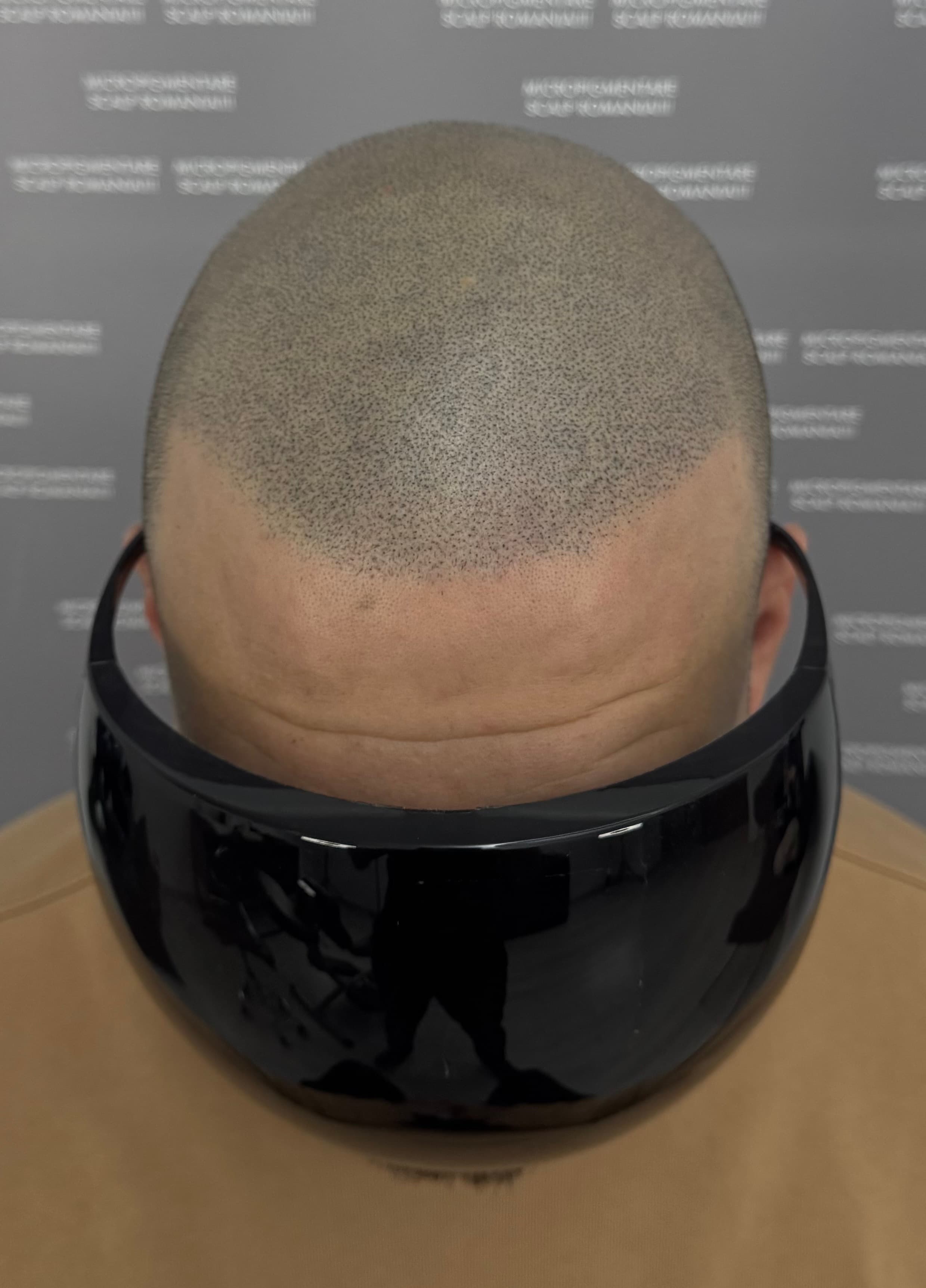 După micropigmentare scalp - Densitate Post Transplant