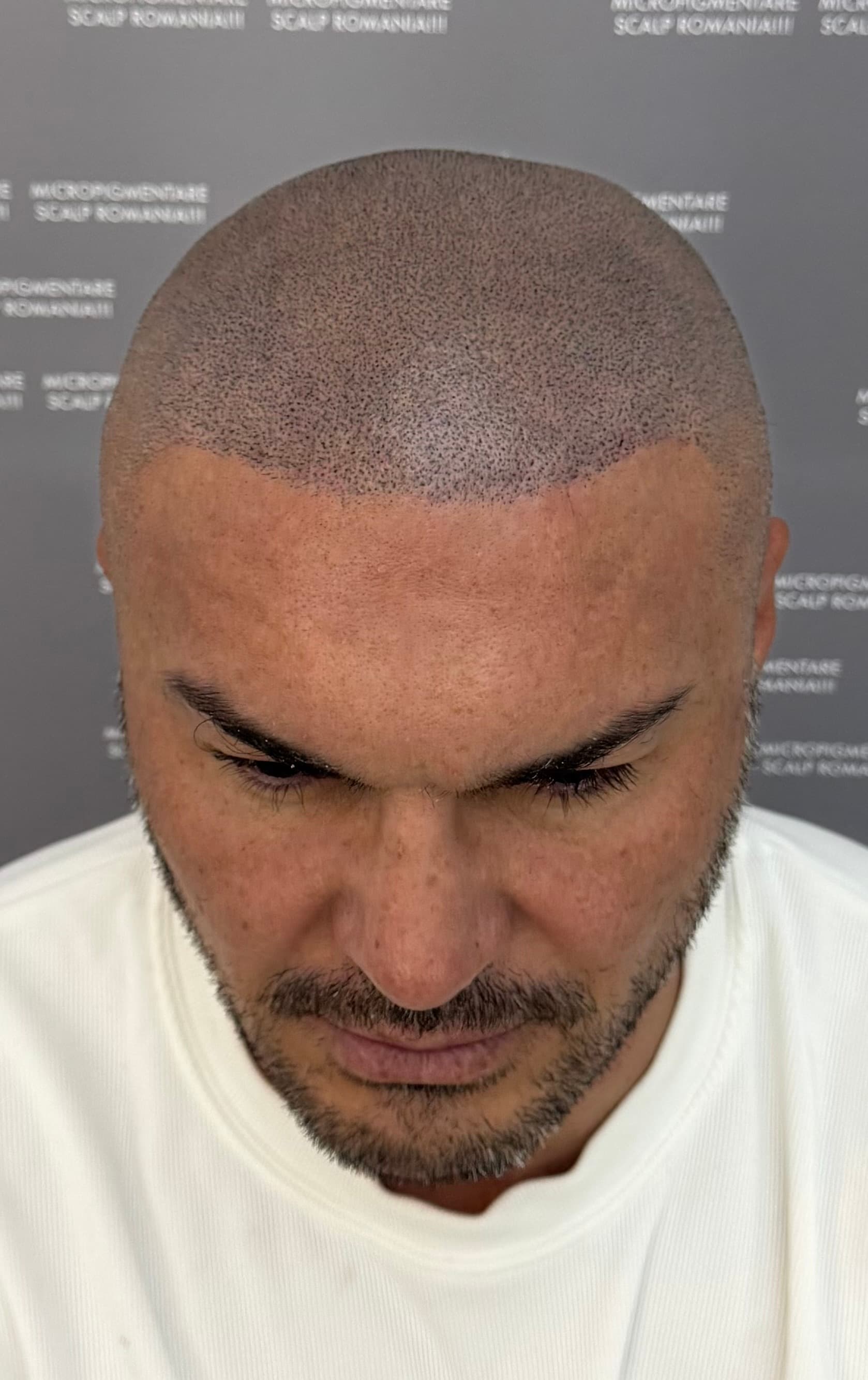 După micropigmentare scalp - Densitate Post Transplant