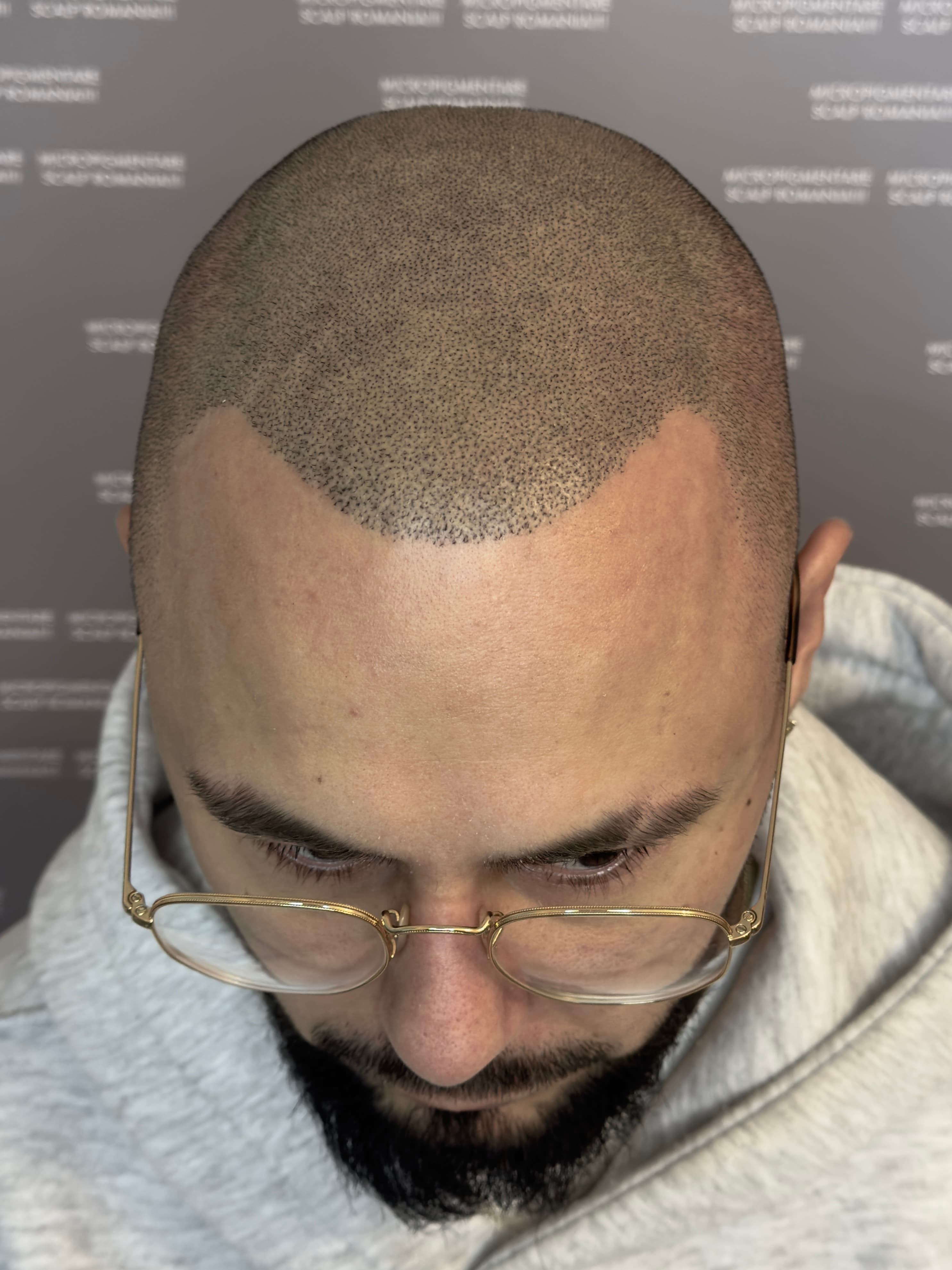 După micropigmentare scalp - Densitate Post Transplant