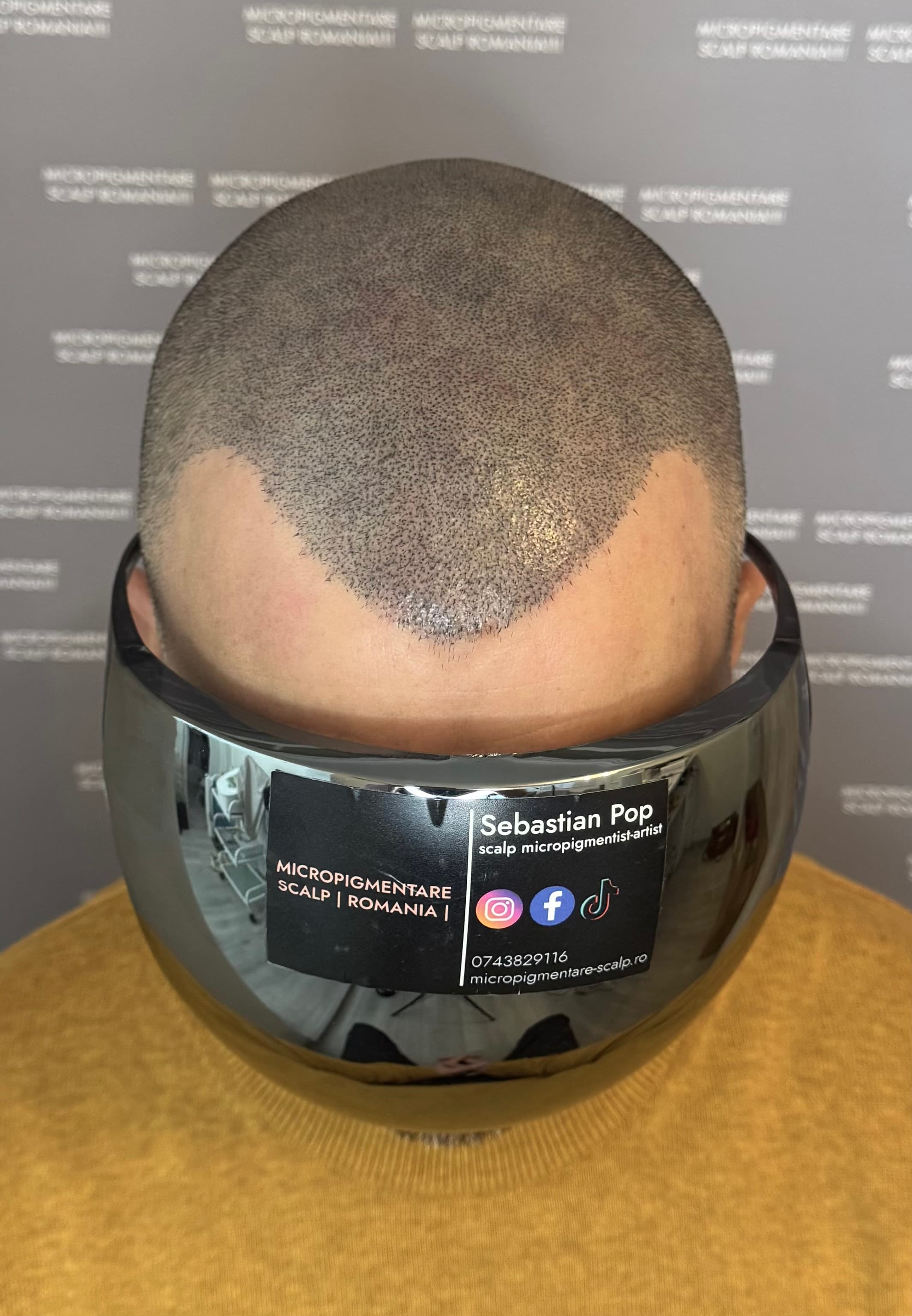După micropigmentare scalp - Densitate Post Transplant