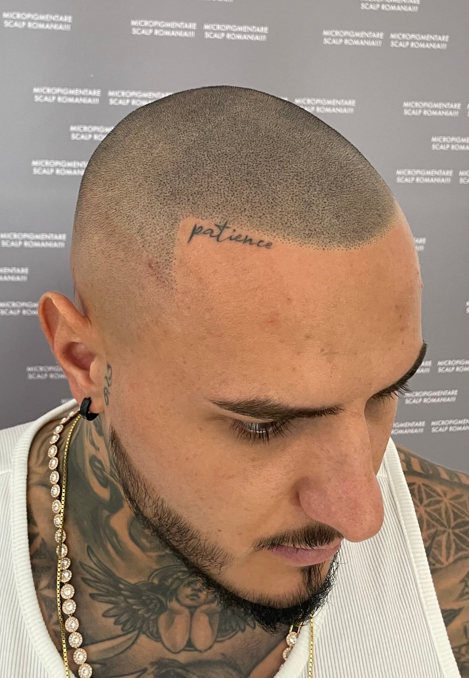 După micropigmentare scalp - Densitate Post Transplant
