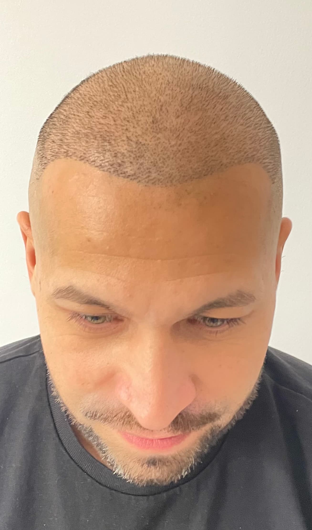 Înainte de micropigmentare scalp - Densitate Post Transplant