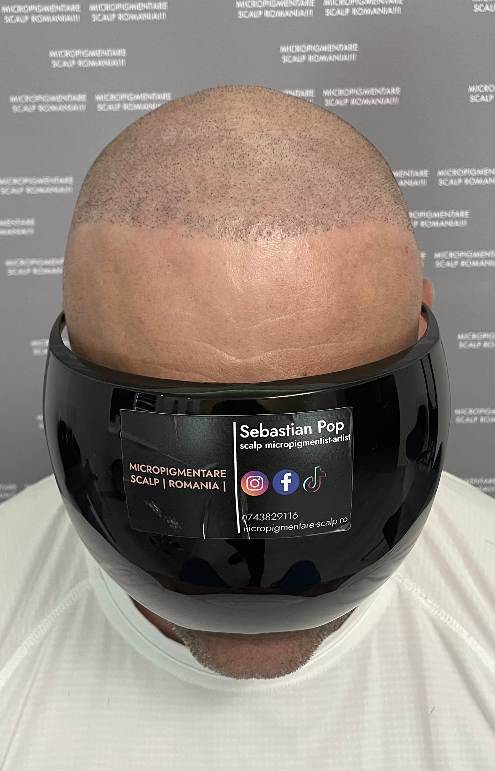 Înainte de micropigmentare scalp - Densitate Post Transplant