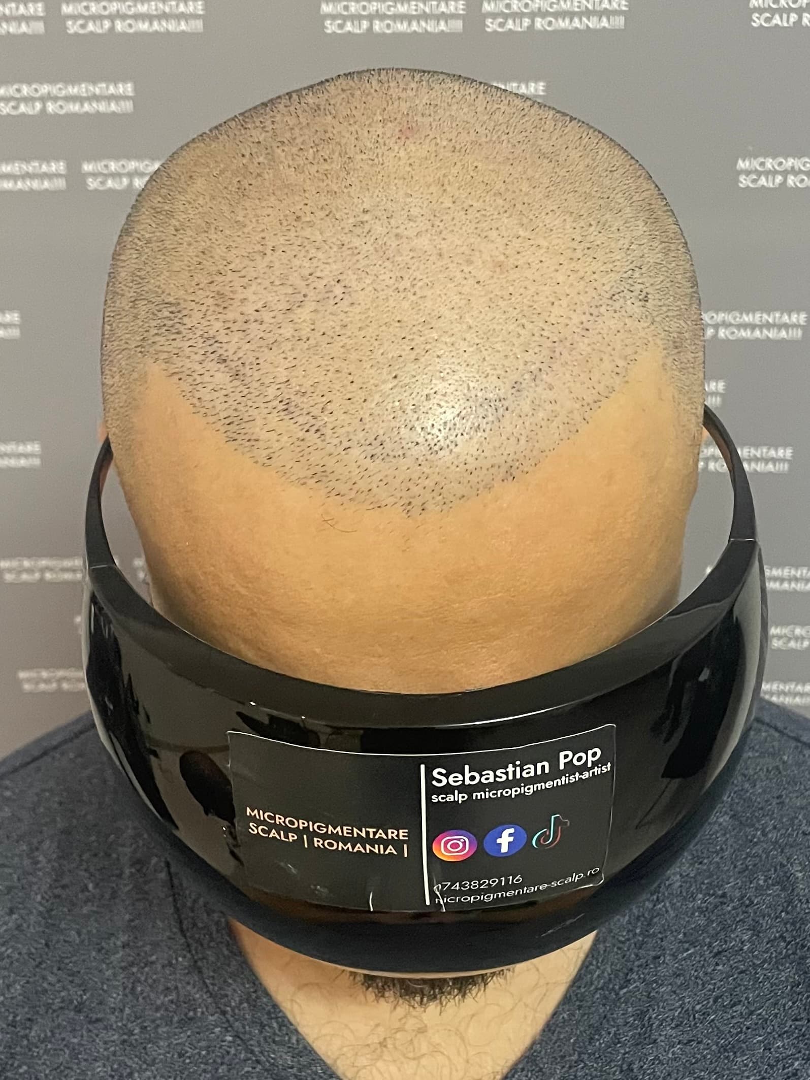 Înainte de micropigmentare scalp - Densitate Post Transplant