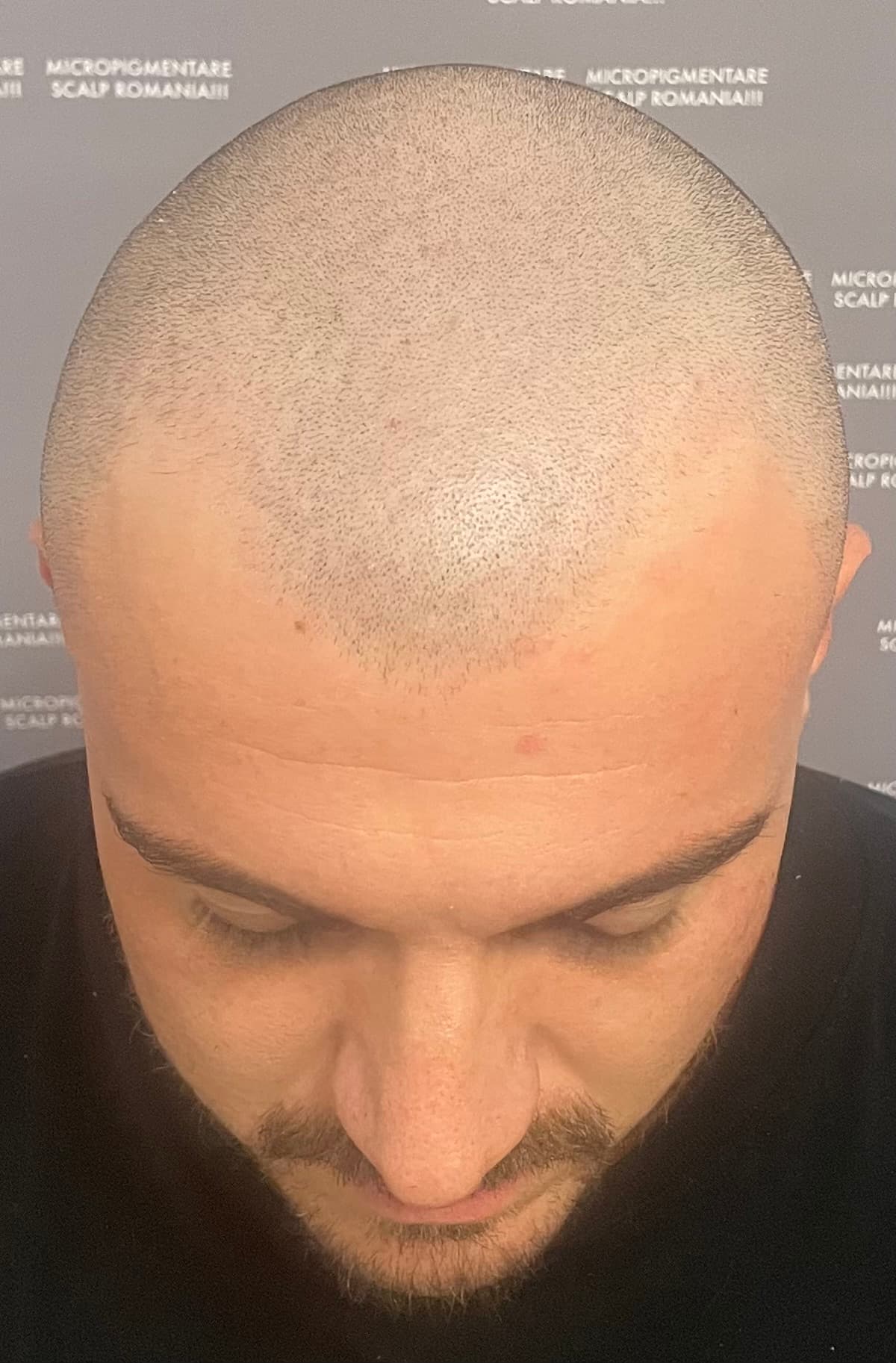 Înainte de micropigmentare scalp - Densitate Post Transplant
