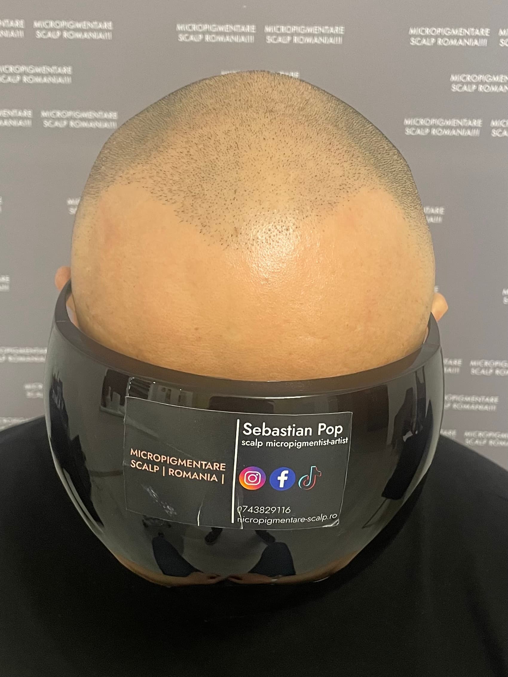 Înainte de micropigmentare scalp - Densitate Post Transplant