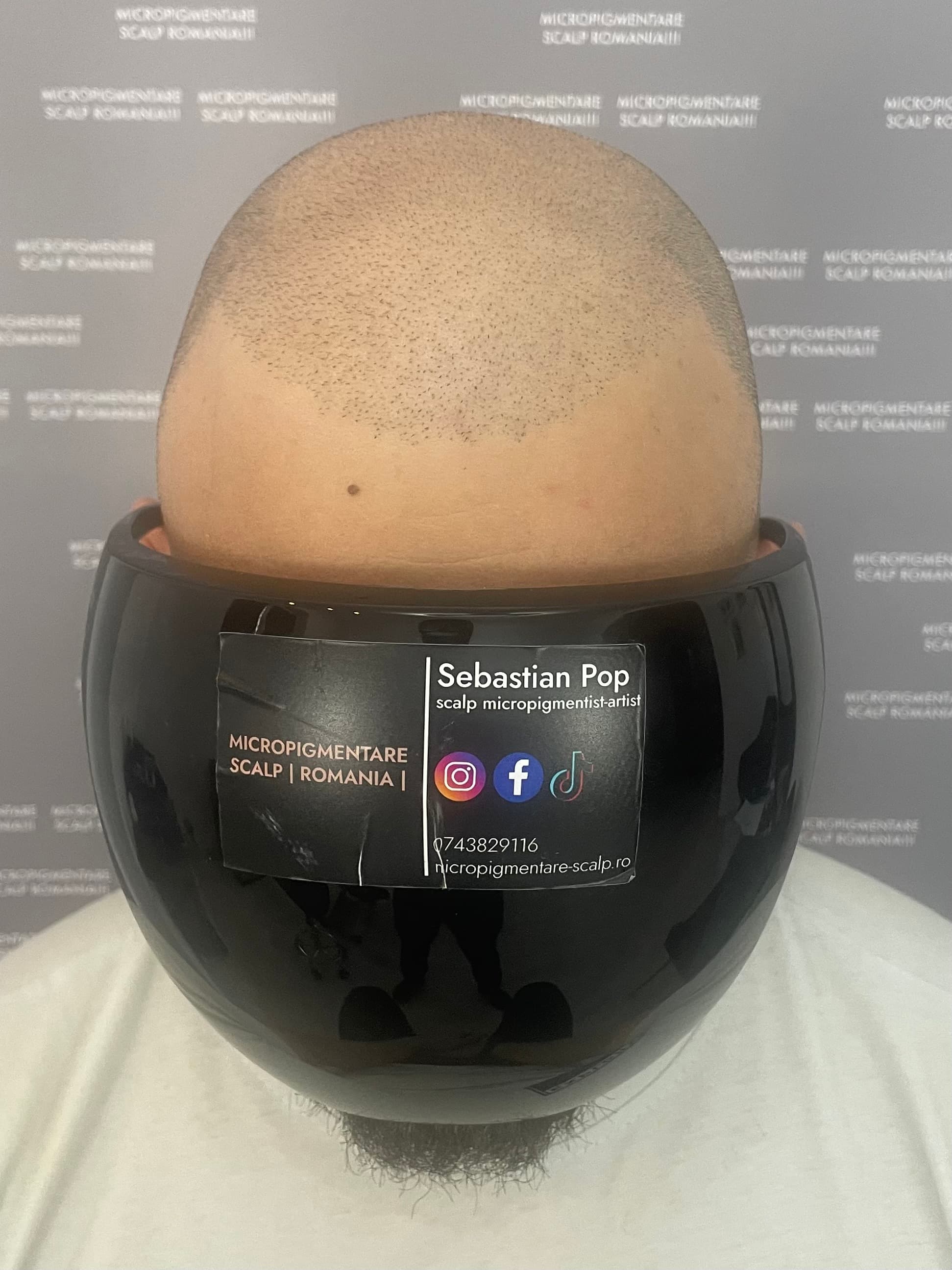 Înainte de micropigmentare scalp - Densitate Post Transplant