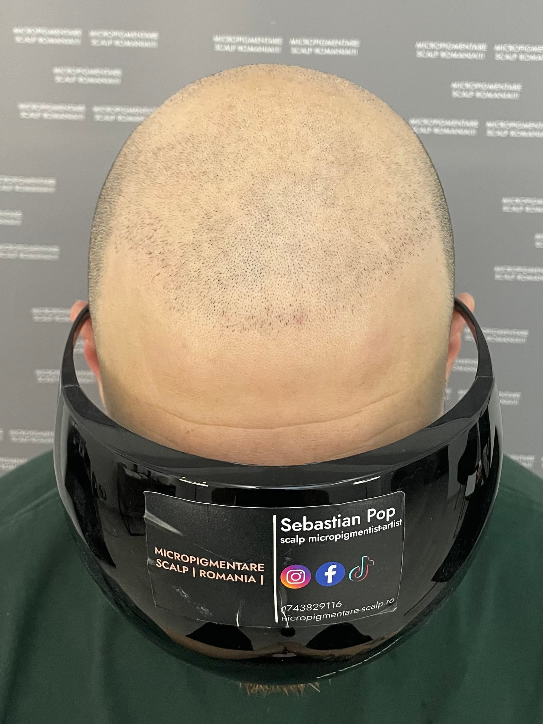 Înainte de micropigmentare scalp - Densitate Post Transplant
