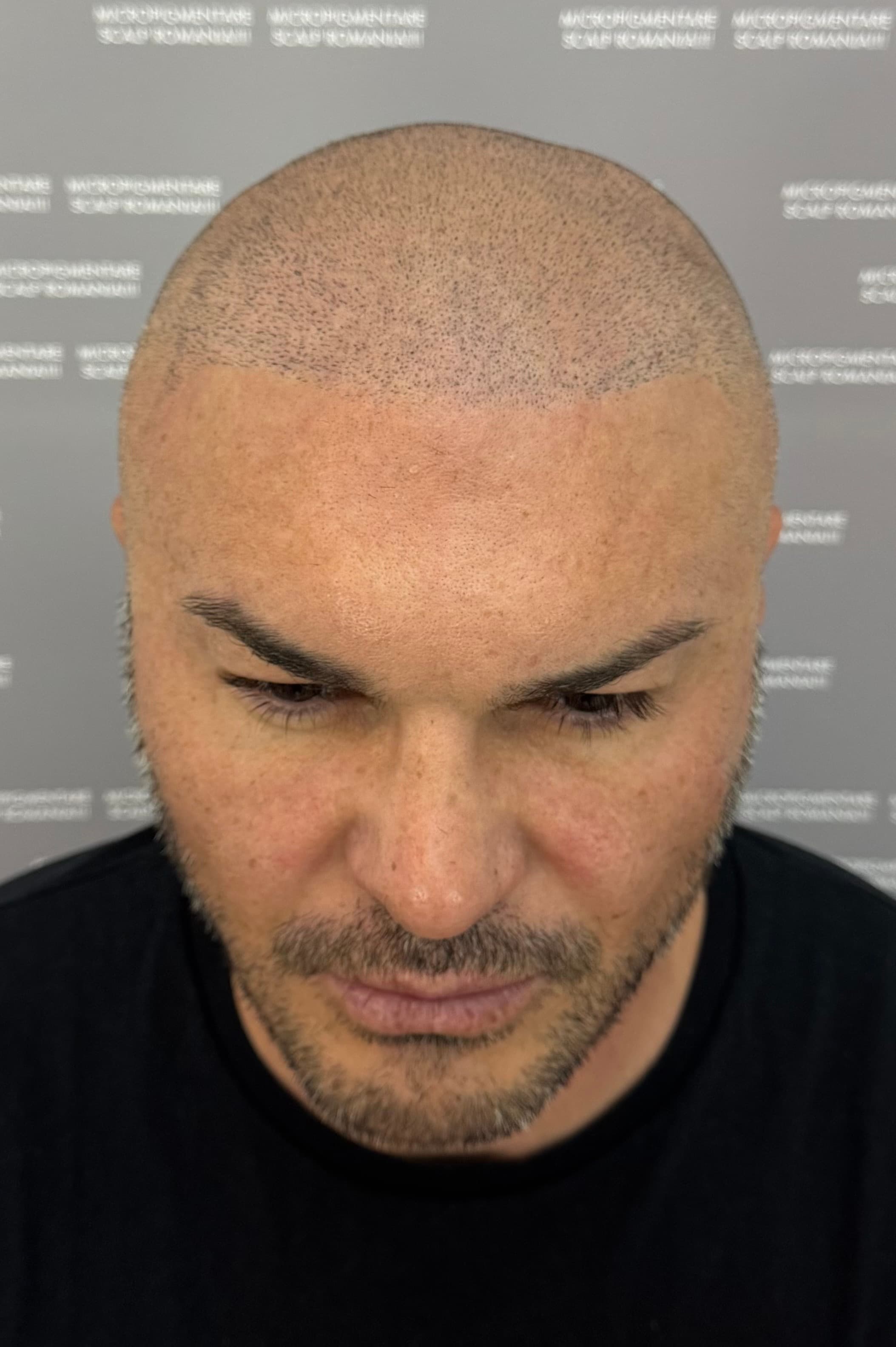 Înainte de micropigmentare scalp - Densitate Post Transplant