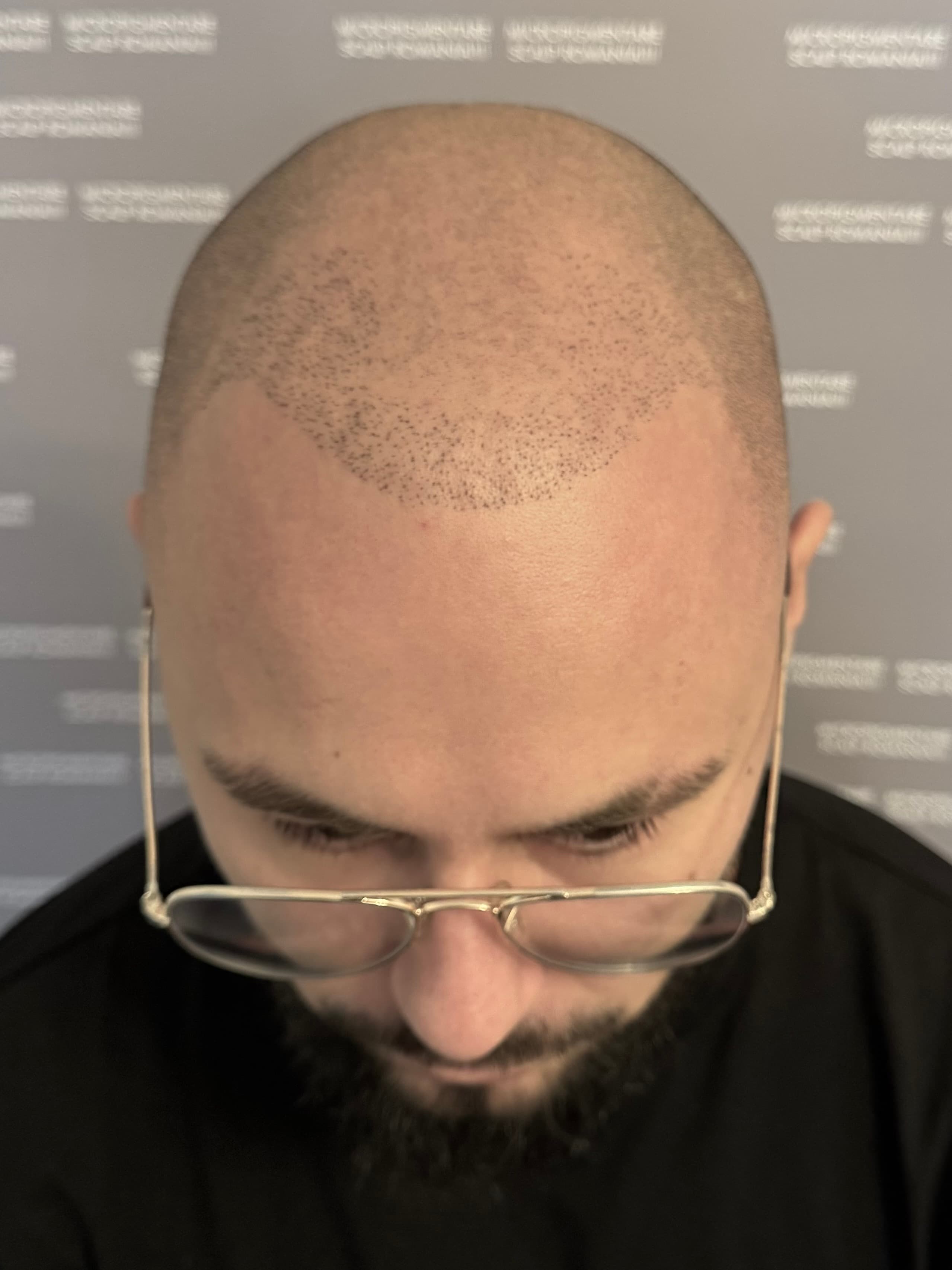 Înainte de micropigmentare scalp - Densitate Post Transplant