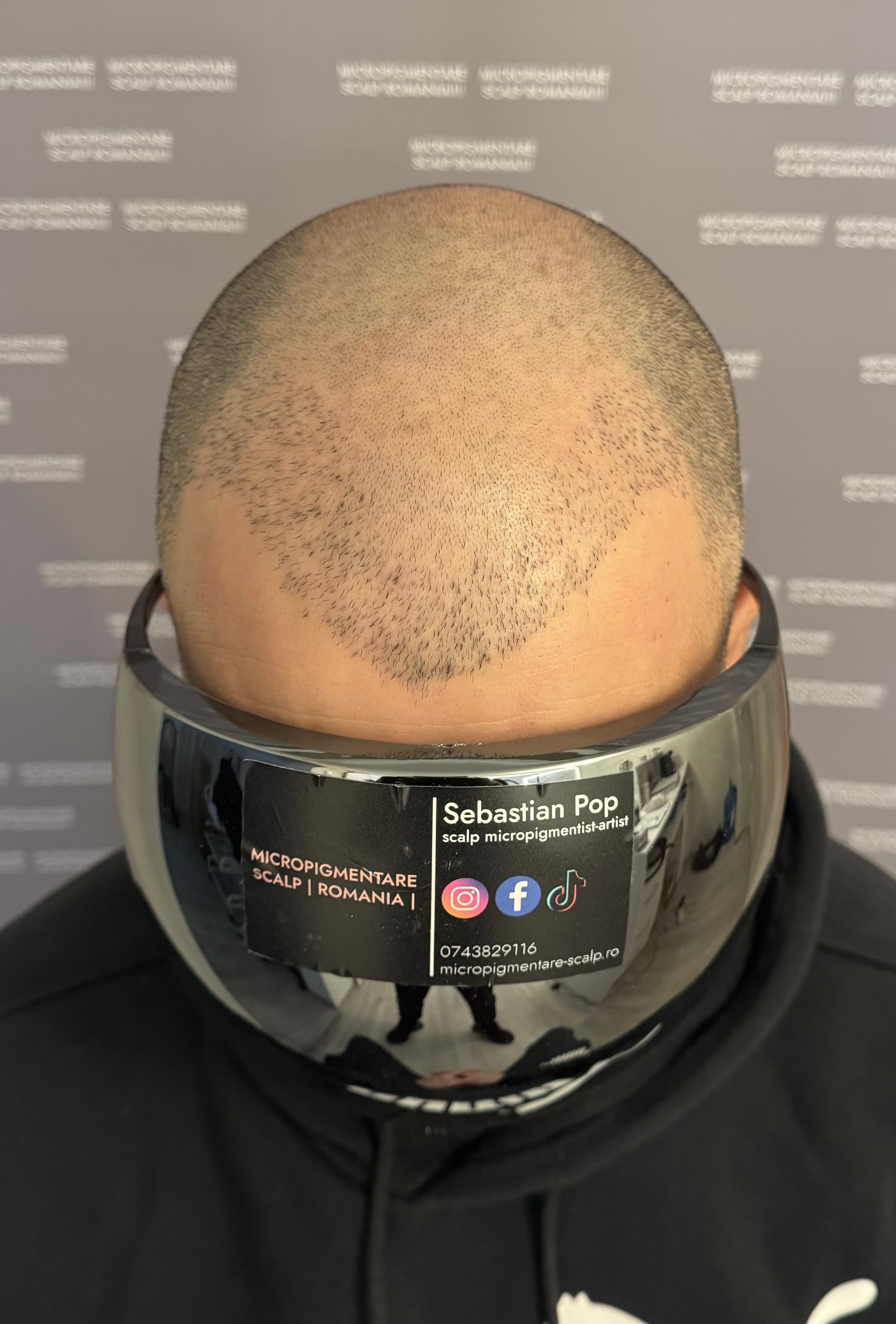 Înainte de micropigmentare scalp - Densitate Post Transplant