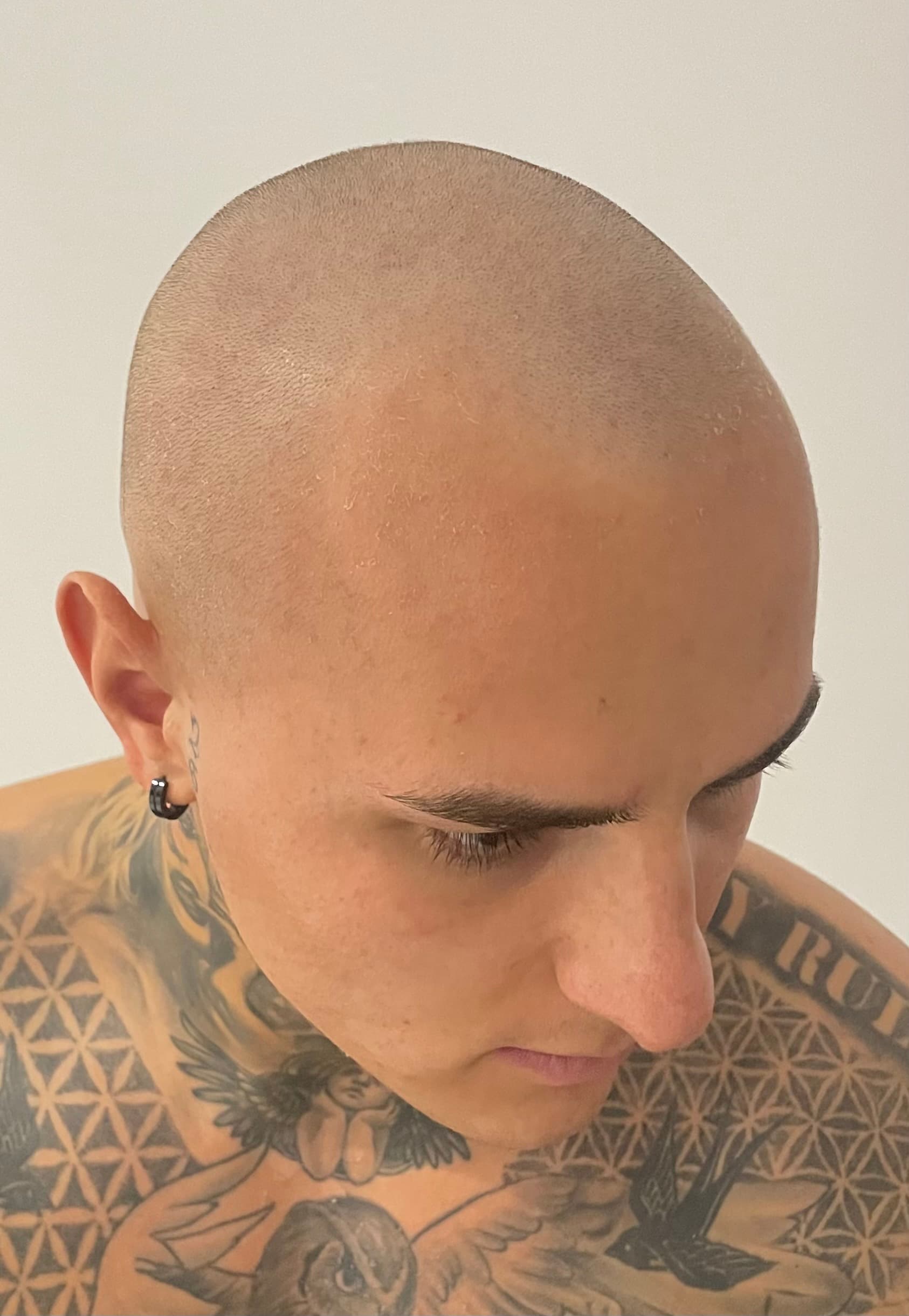 Înainte de micropigmentare scalp - Densitate Post Transplant
